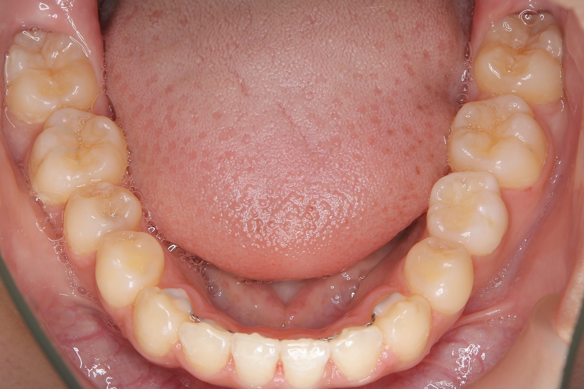 全顎ワイヤー矯正　症例_418