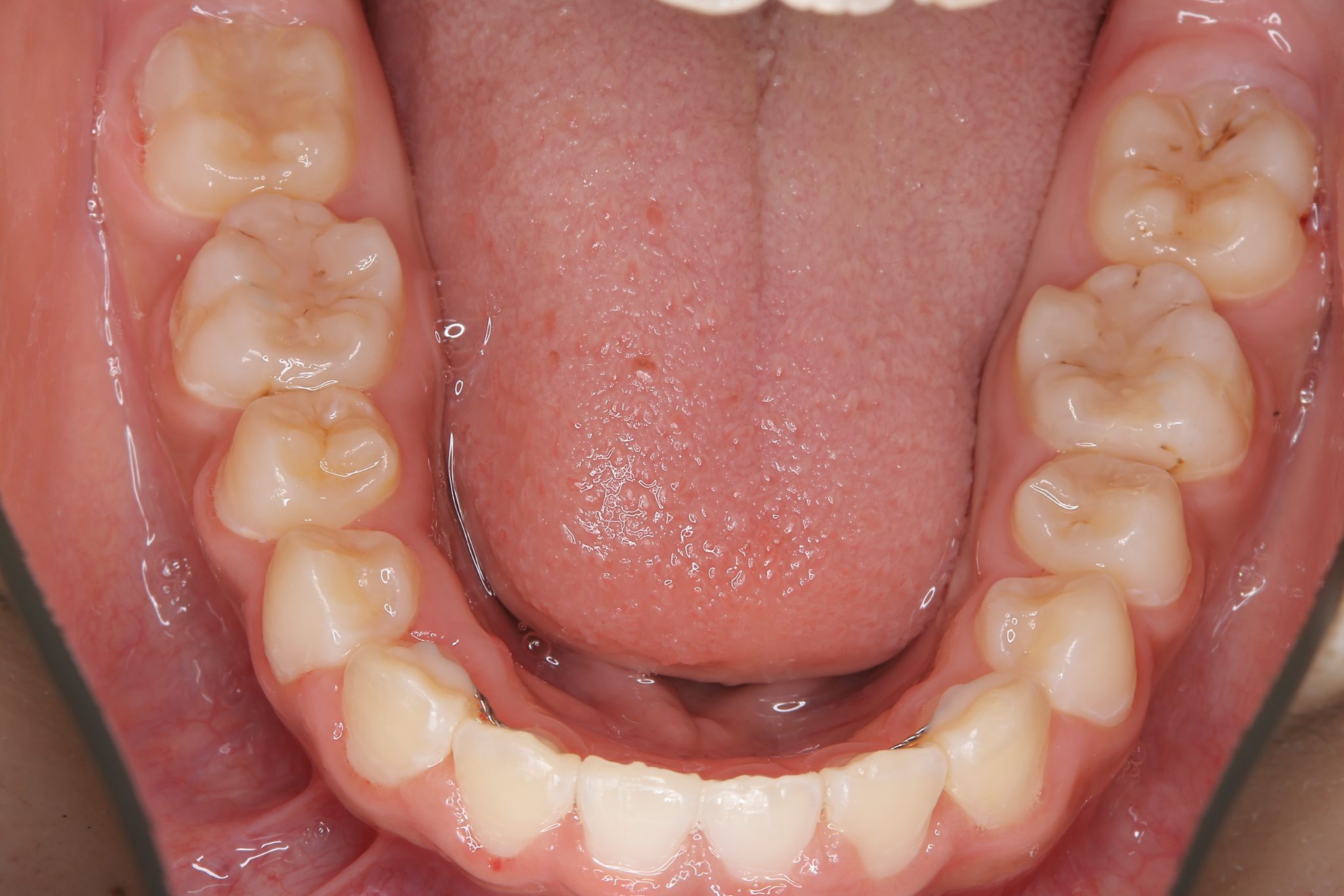 全顎ワイヤー矯正　症例_474