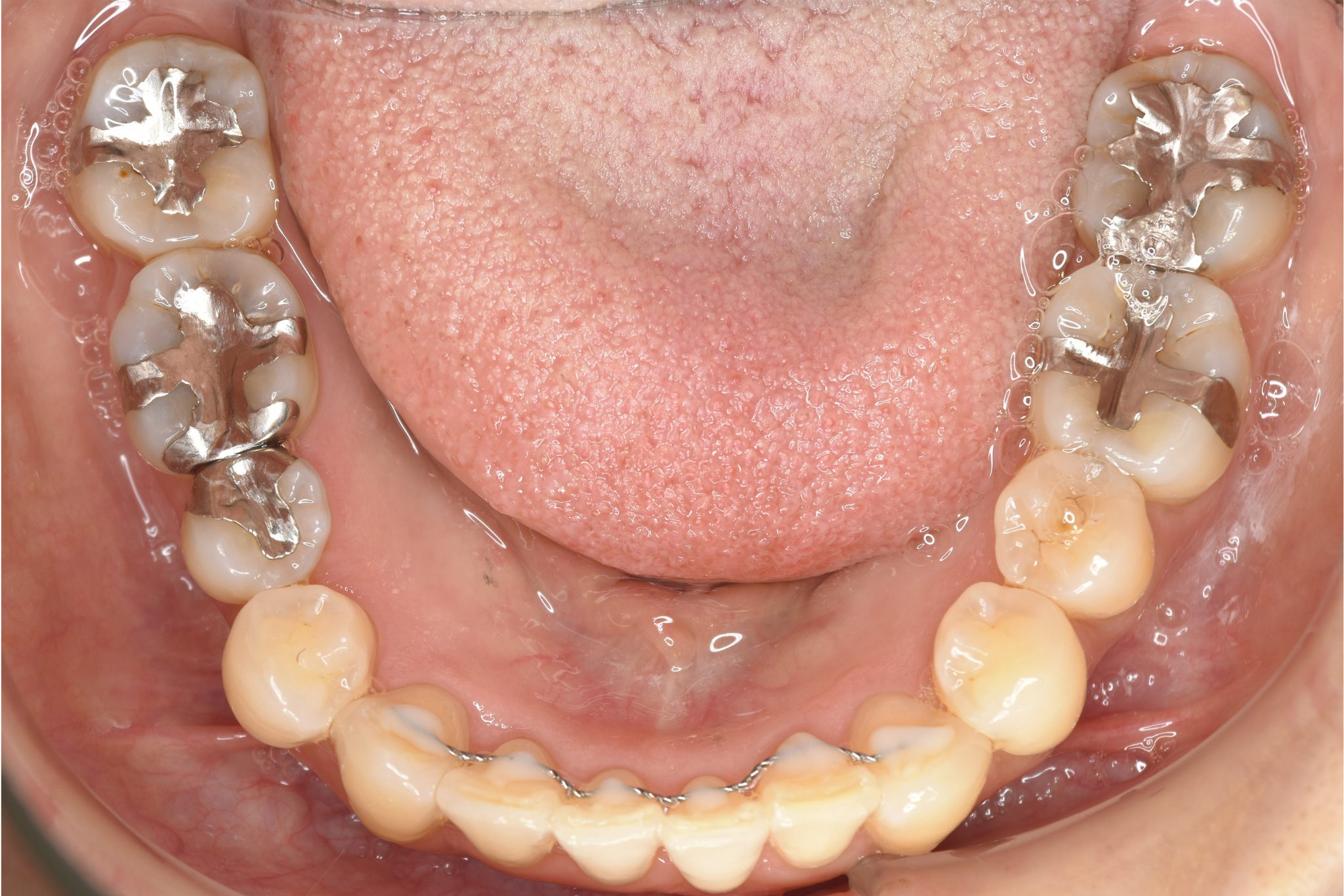 全顎ワイヤー矯正　症例_479