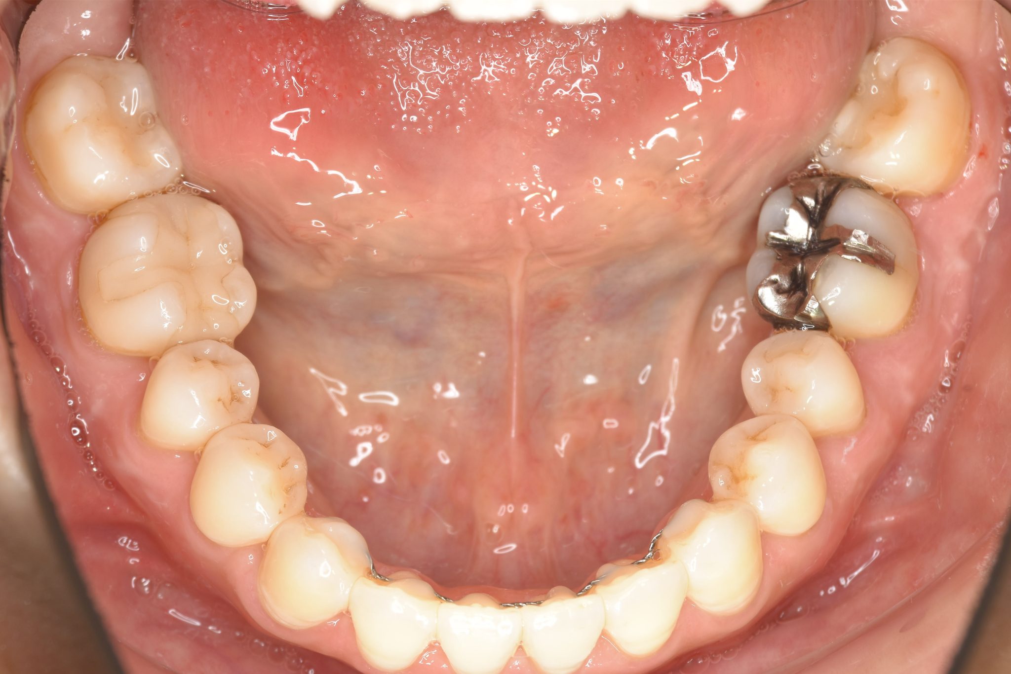 全顎ワイヤー矯正　症例_138