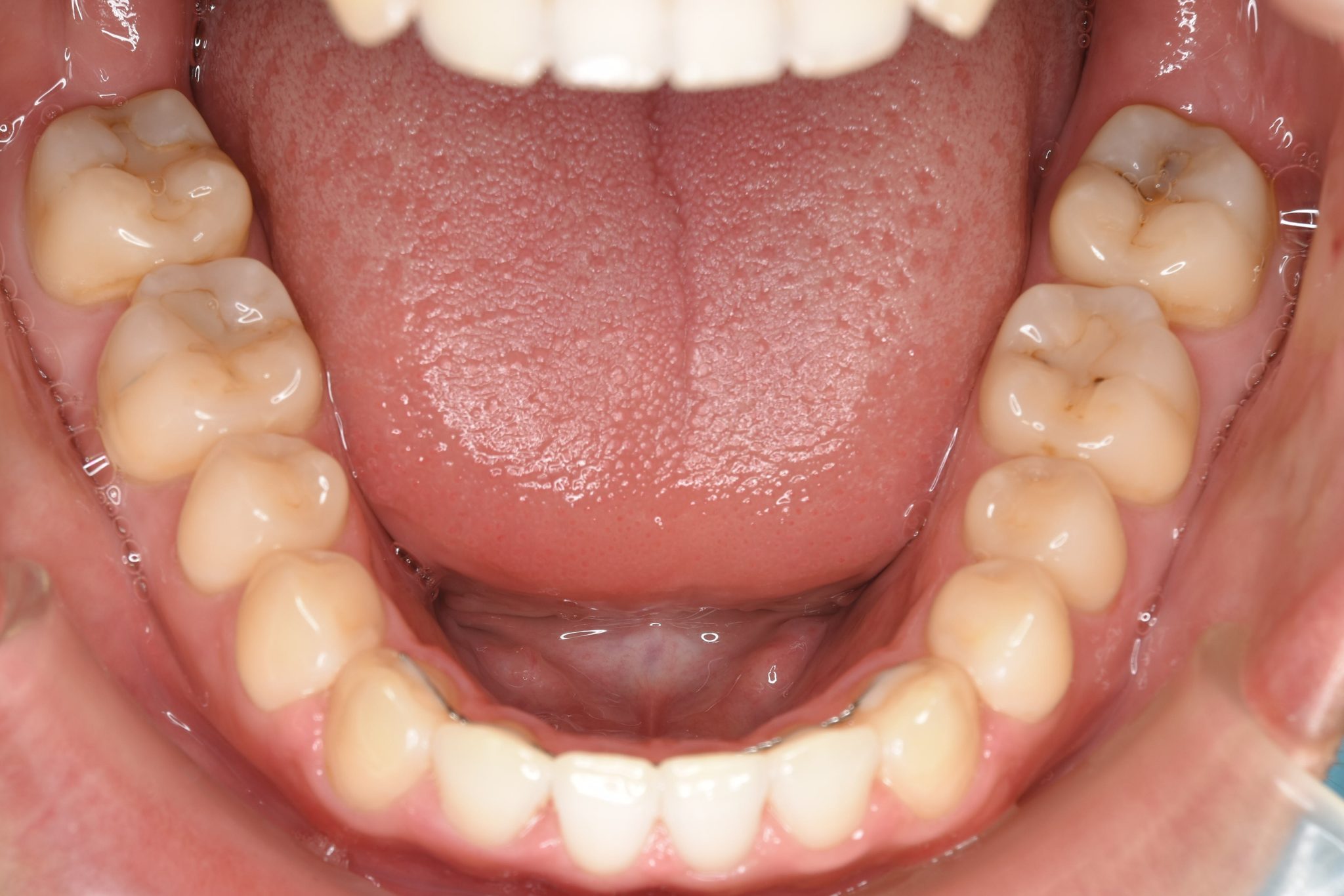 全顎ワイヤー矯正　症例_495