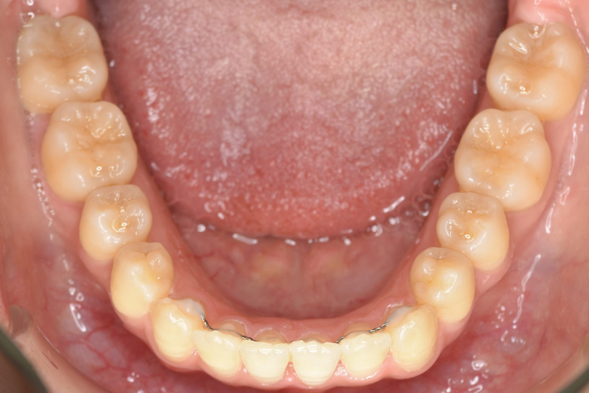 全顎ワイヤー矯正　症例_500