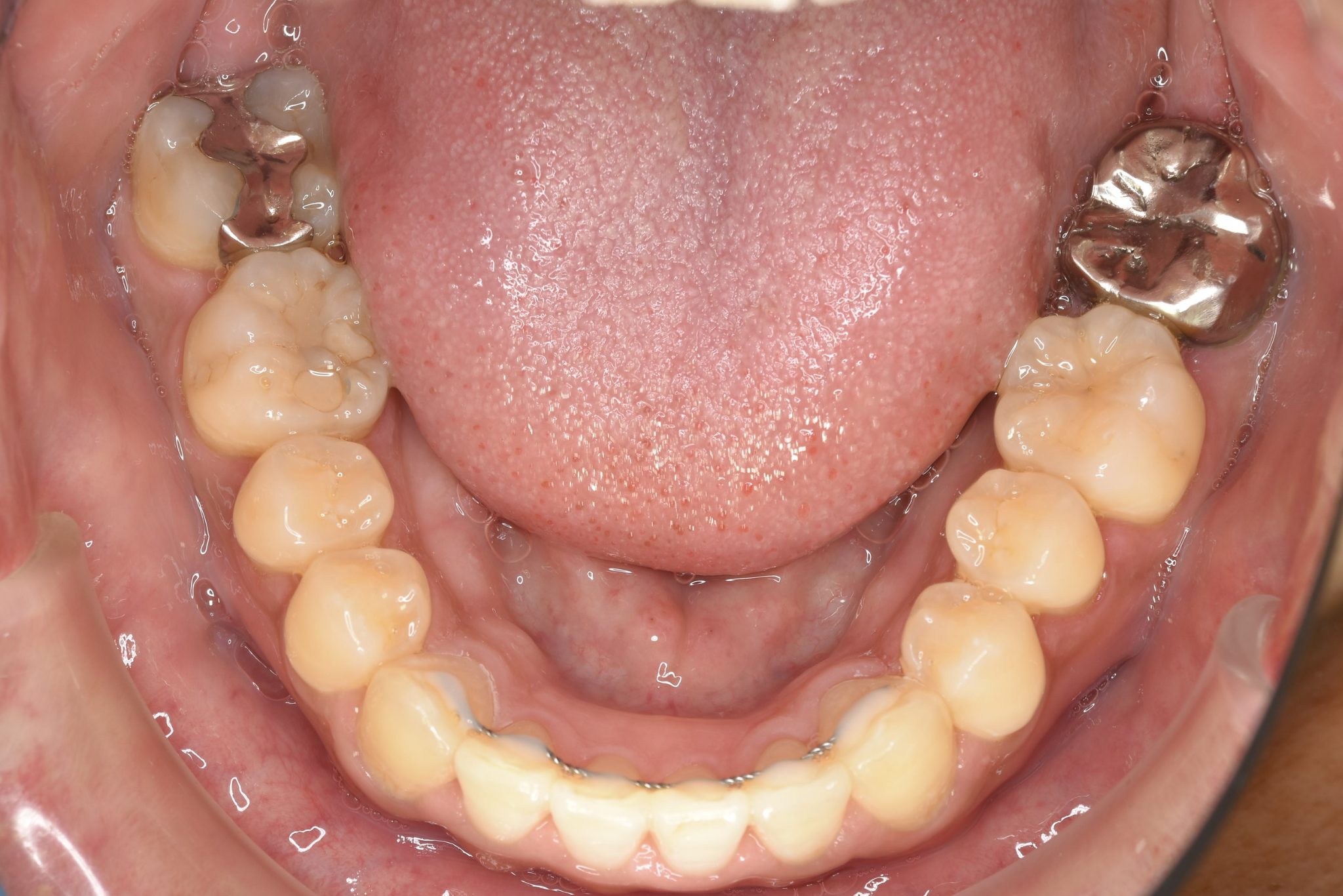 全顎ワイヤー矯正　症例_510