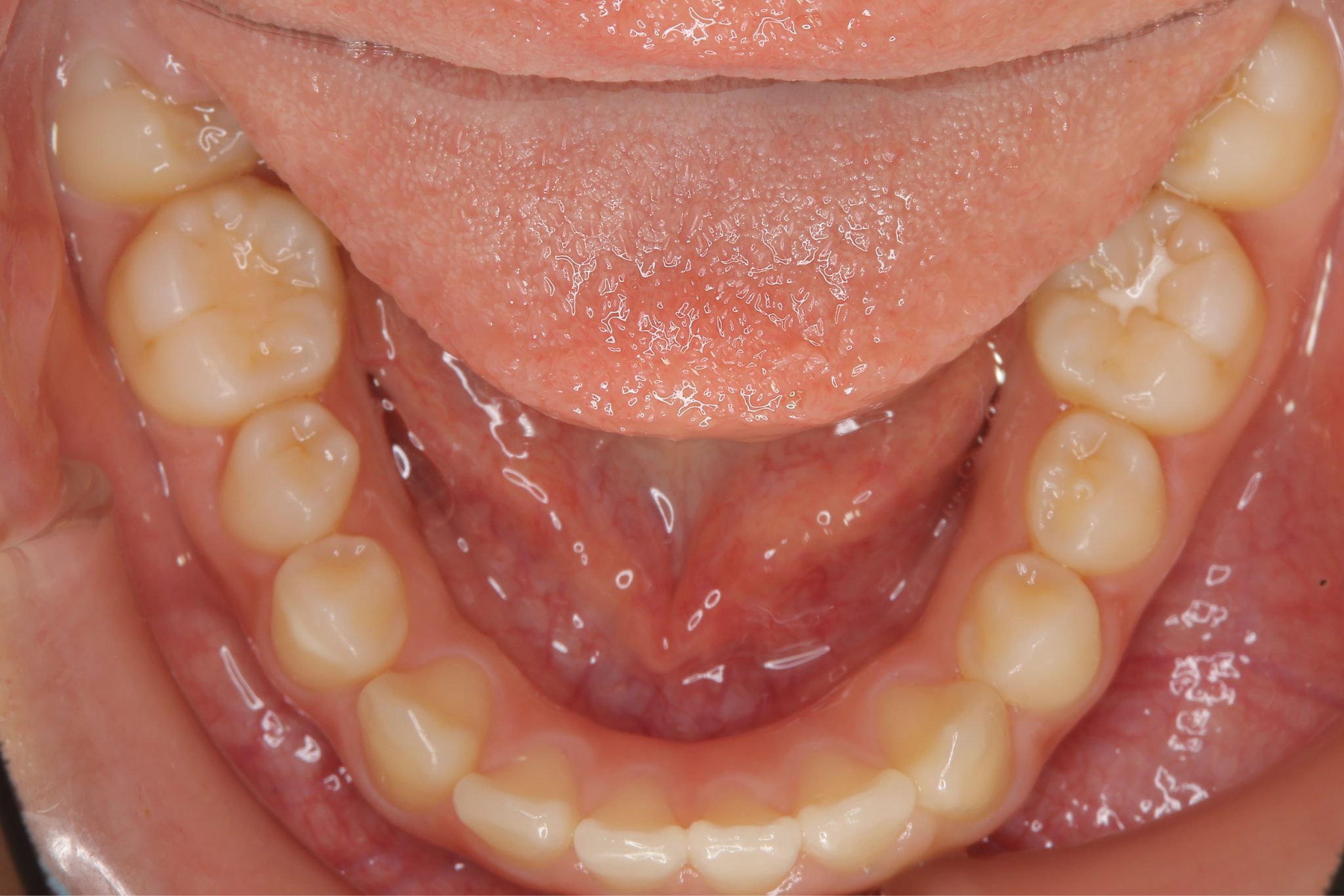 全顎ワイヤー矯正　症例_547