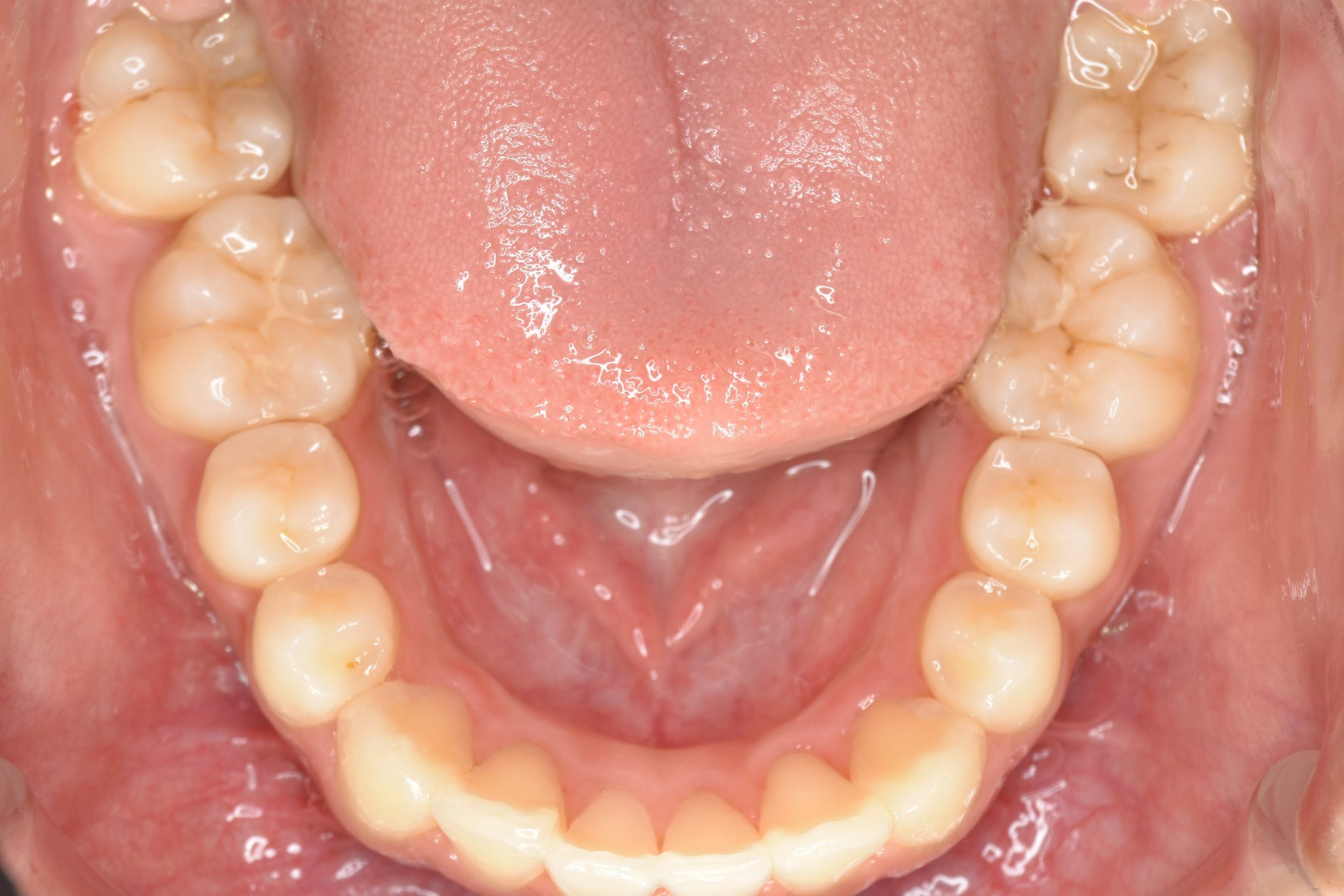 全顎ワイヤー矯正　症例_551