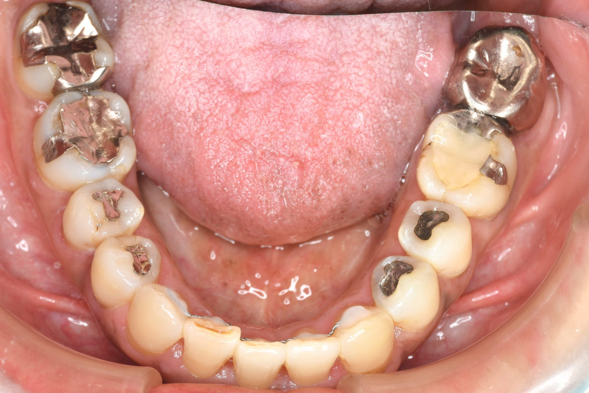 全顎ワイヤー矯正　症例_588