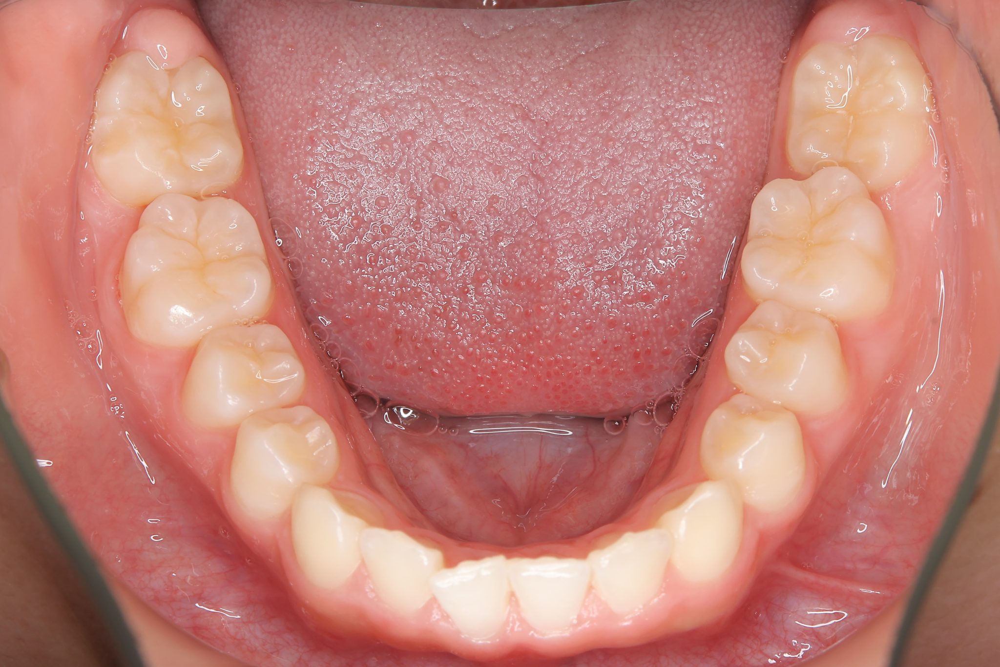 全顎ワイヤー矯正　症例_610