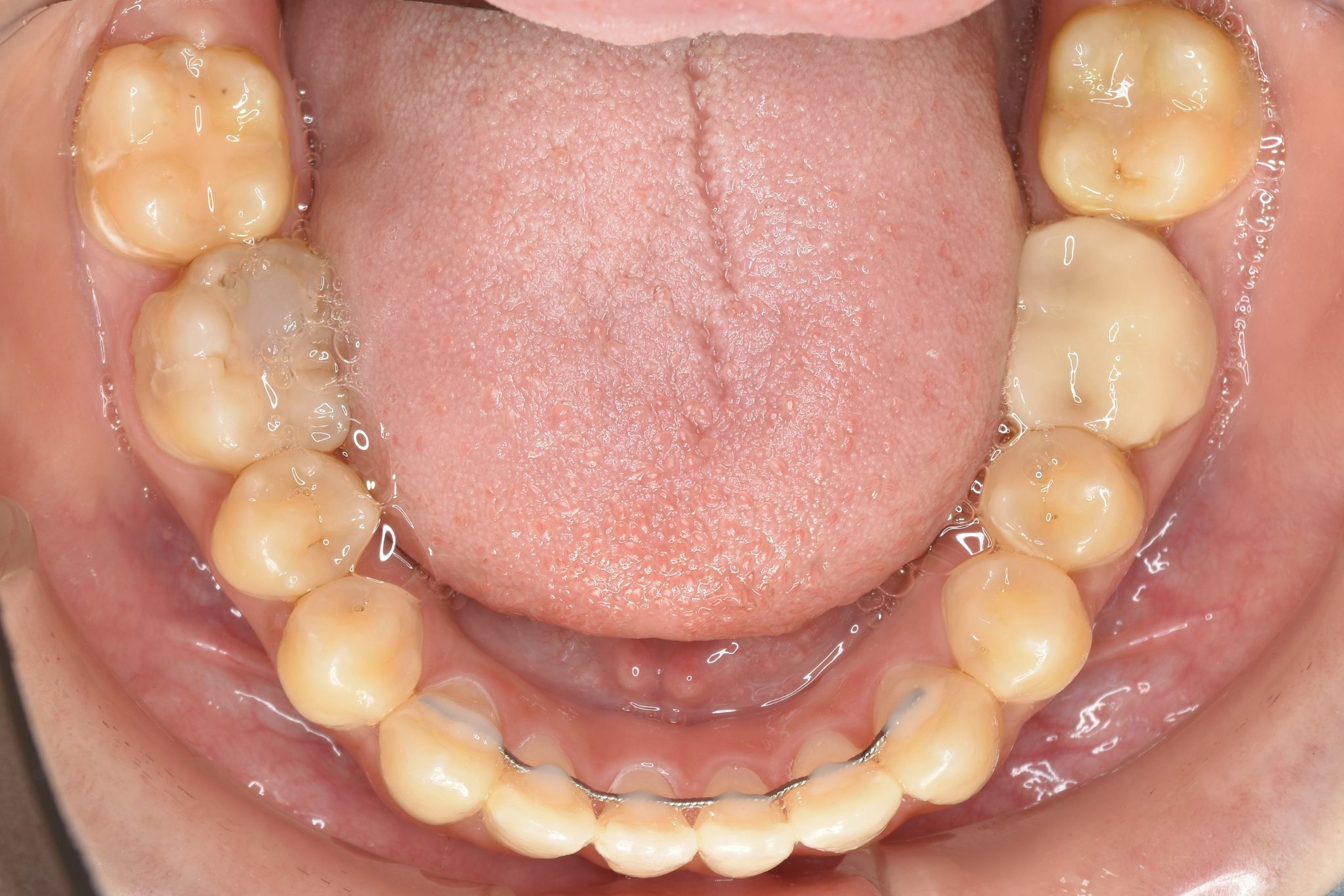 全顎ワイヤー矯正　症例_640