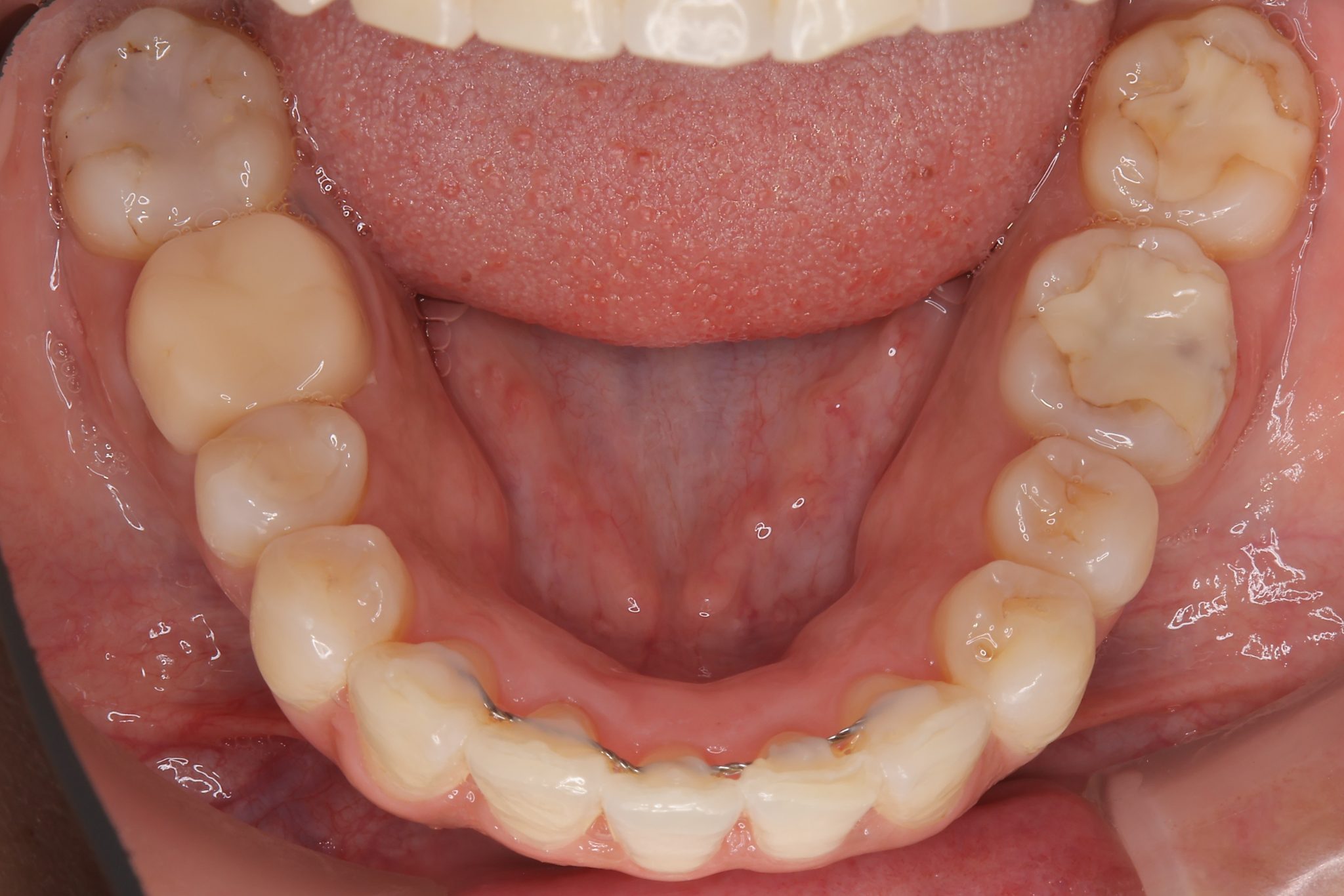 全顎ワイヤー矯正　症例_649