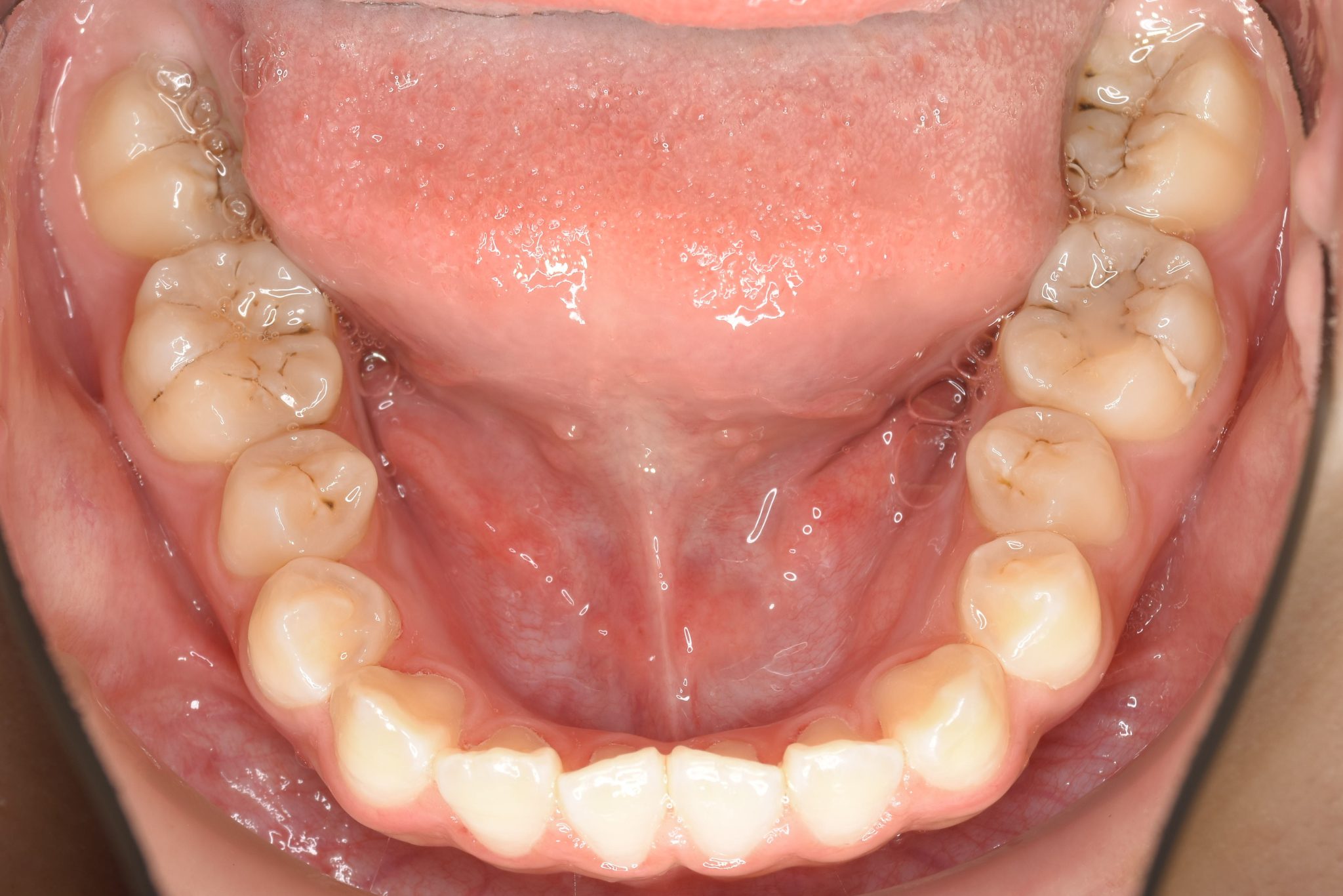 全顎ワイヤー矯正　症例_139