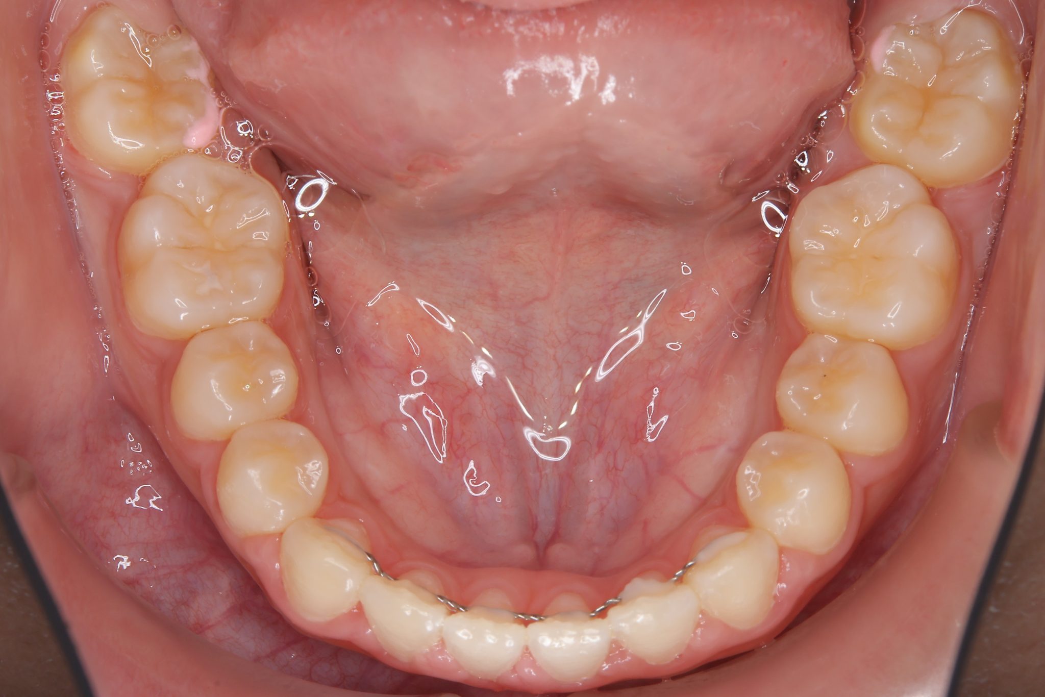 全顎ワイヤー矯正　症例_681