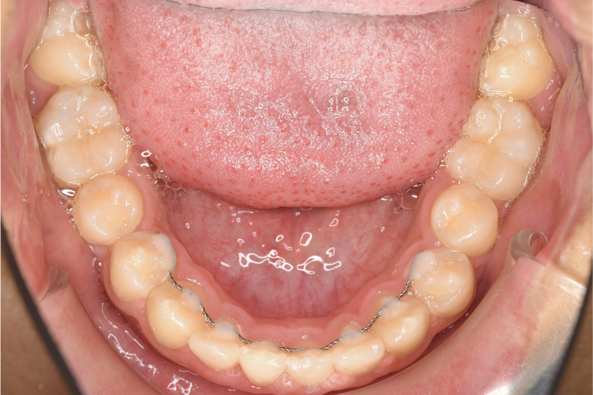 全顎ワイヤー矯正　症例_758