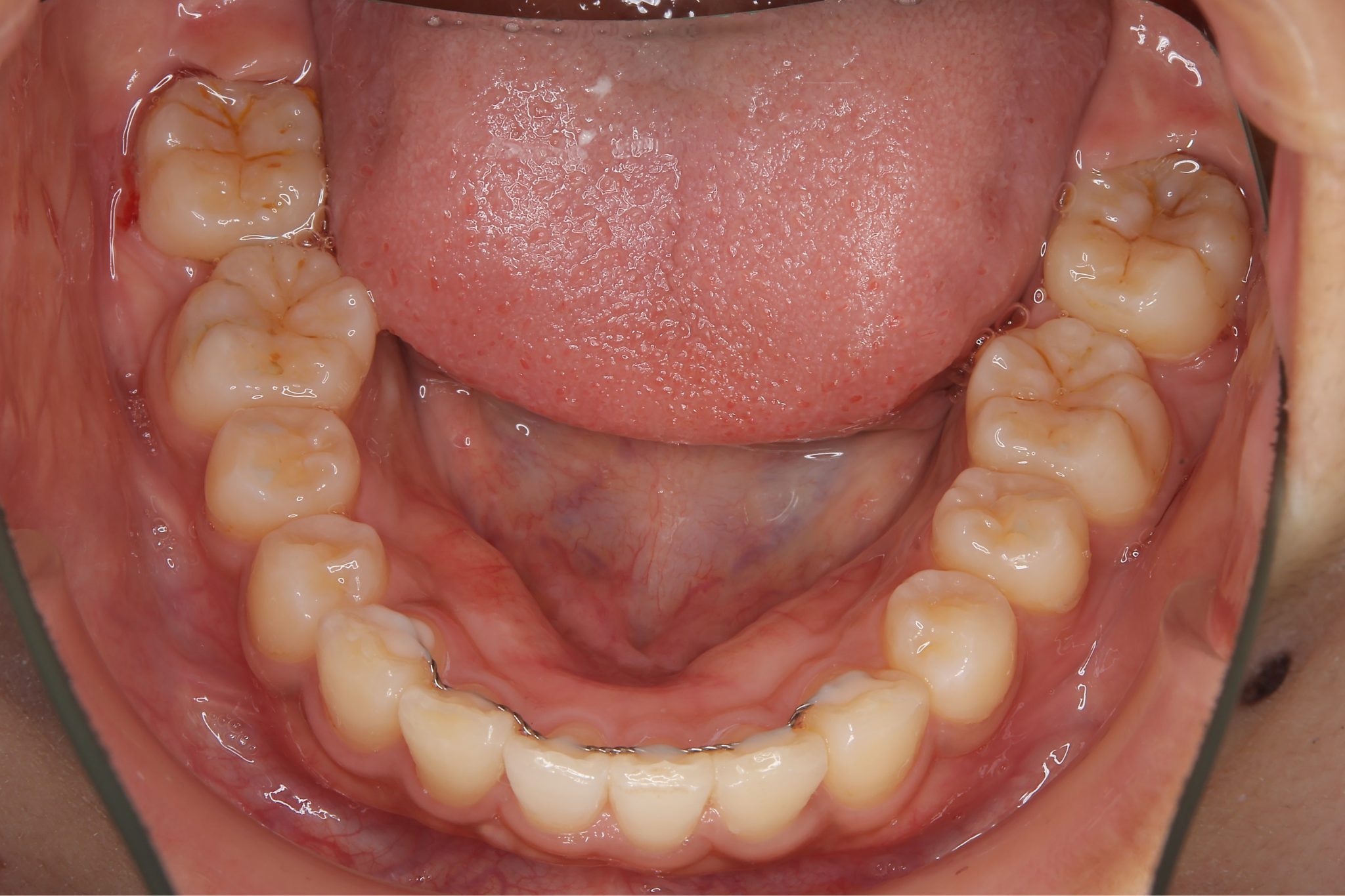 全顎ワイヤー矯正　症例_793