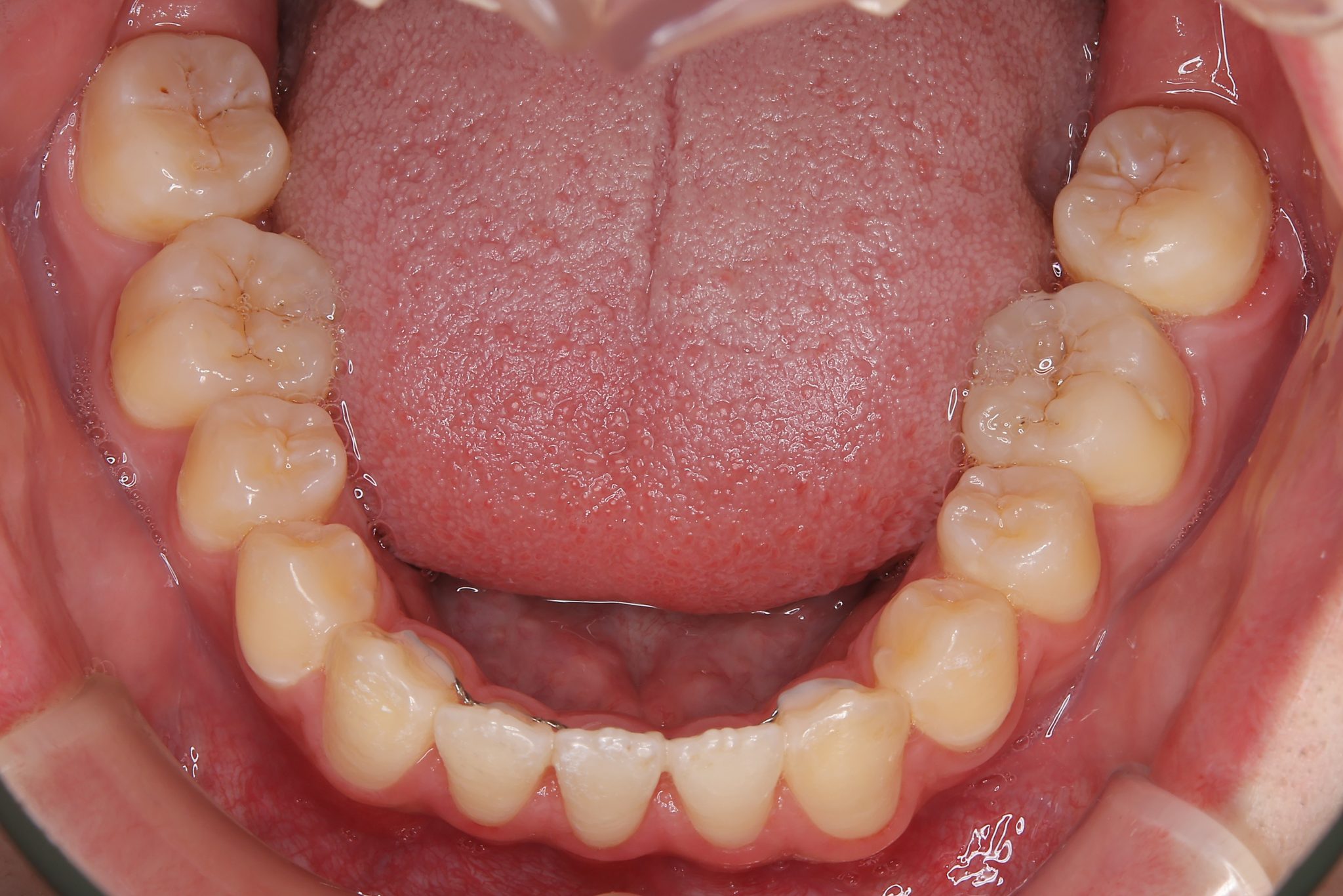 全顎ワイヤー矯正　症例_798