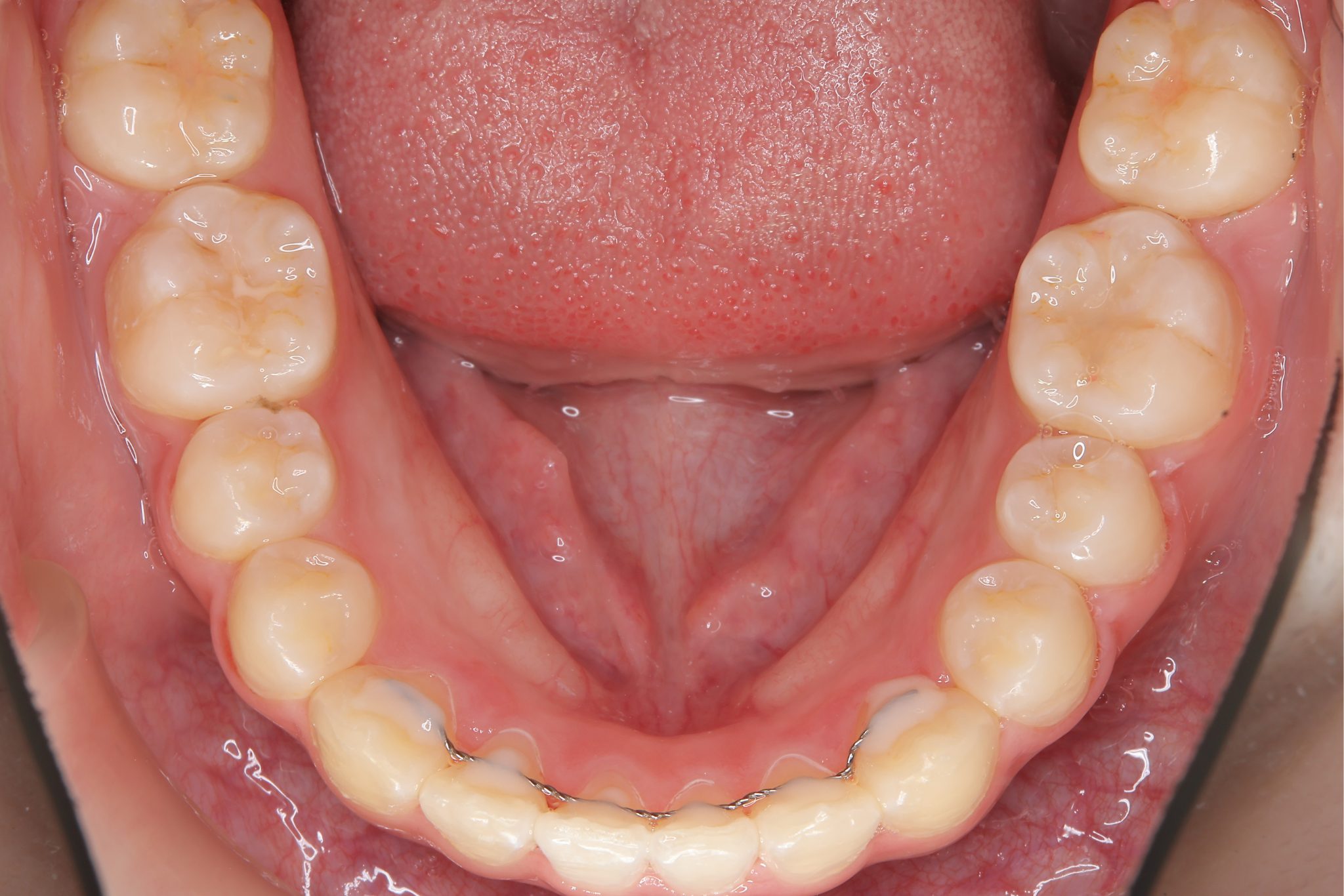 全顎ワイヤー矯正　症例_805