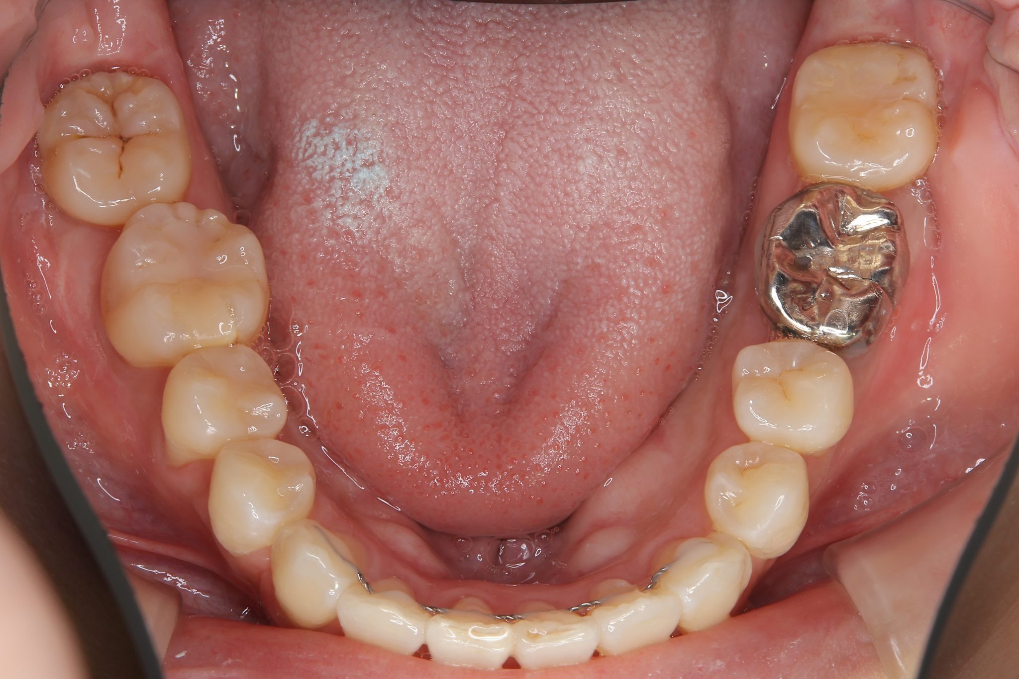 全顎ワイヤー矯正　症例_814