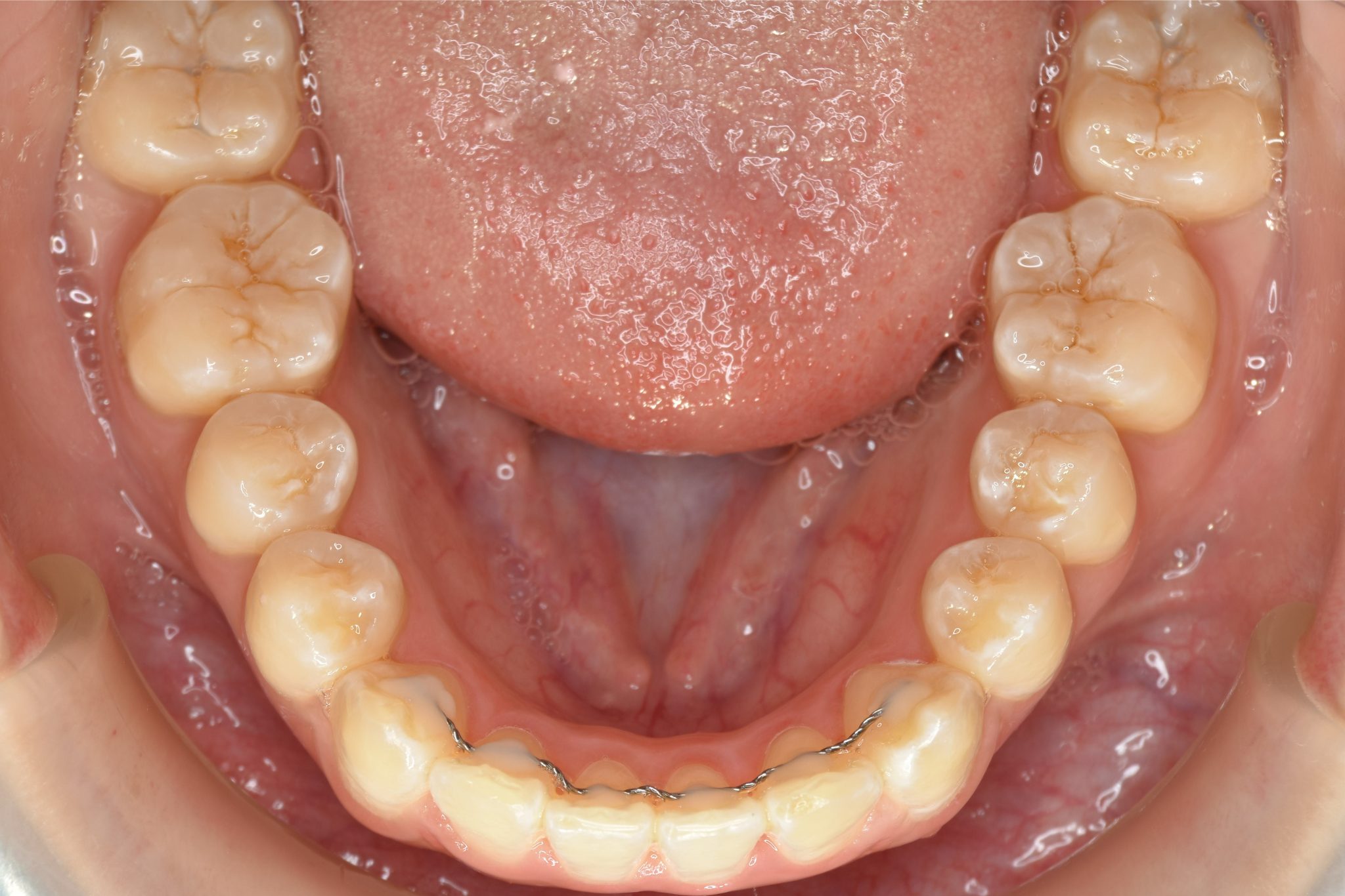 全顎ワイヤー矯正　症例_815