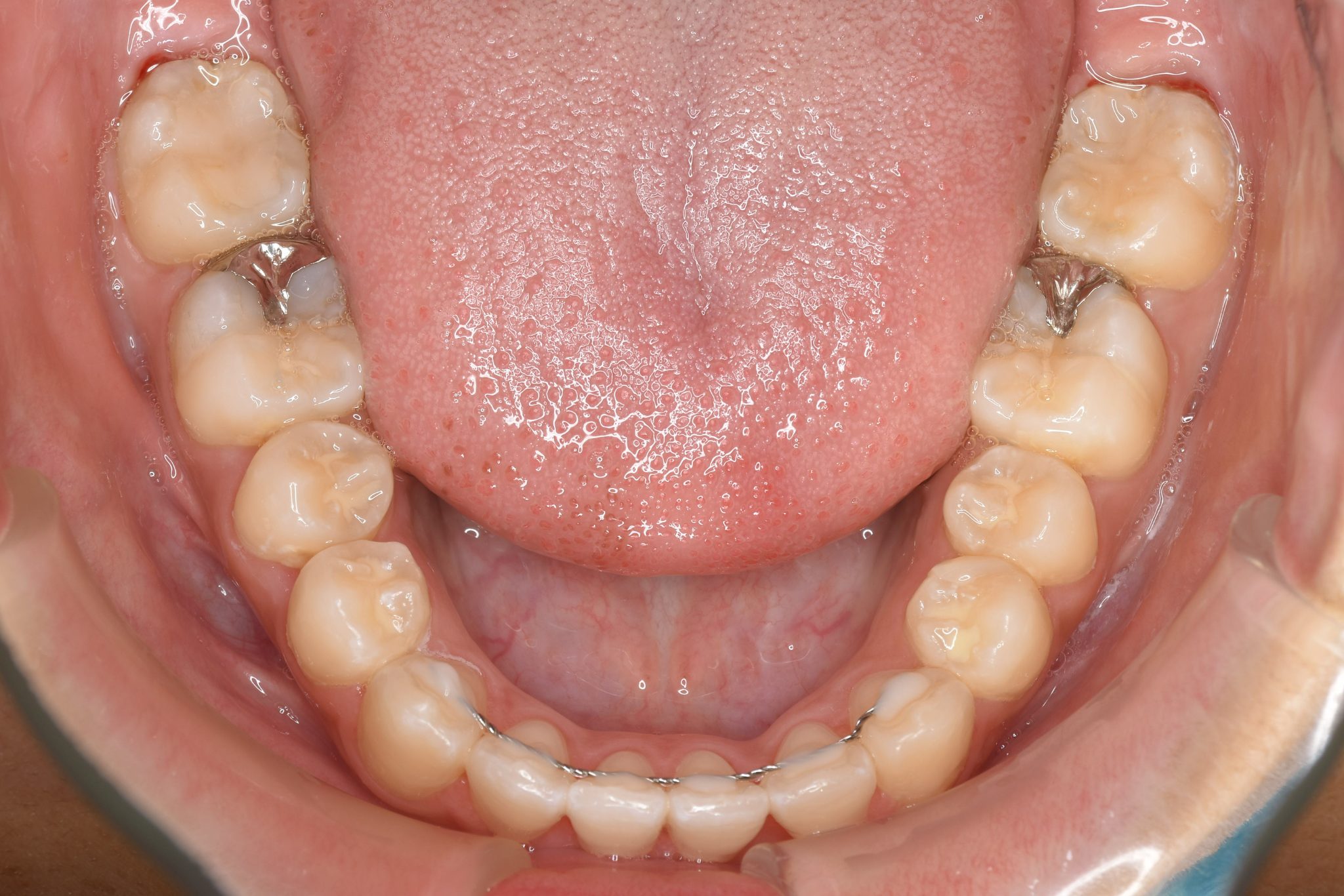 全顎ワイヤー矯正　症例_839