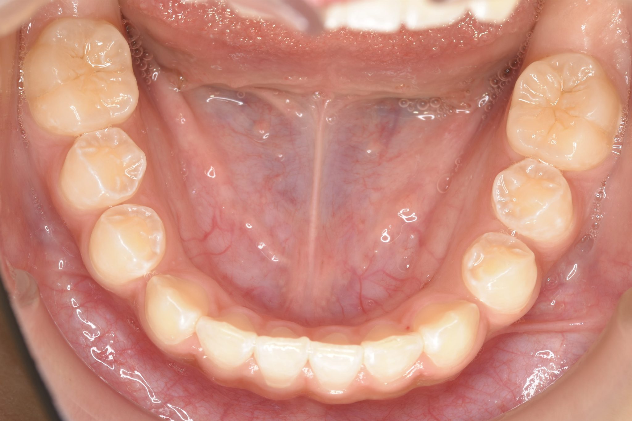 全顎ワイヤー矯正　症例_858