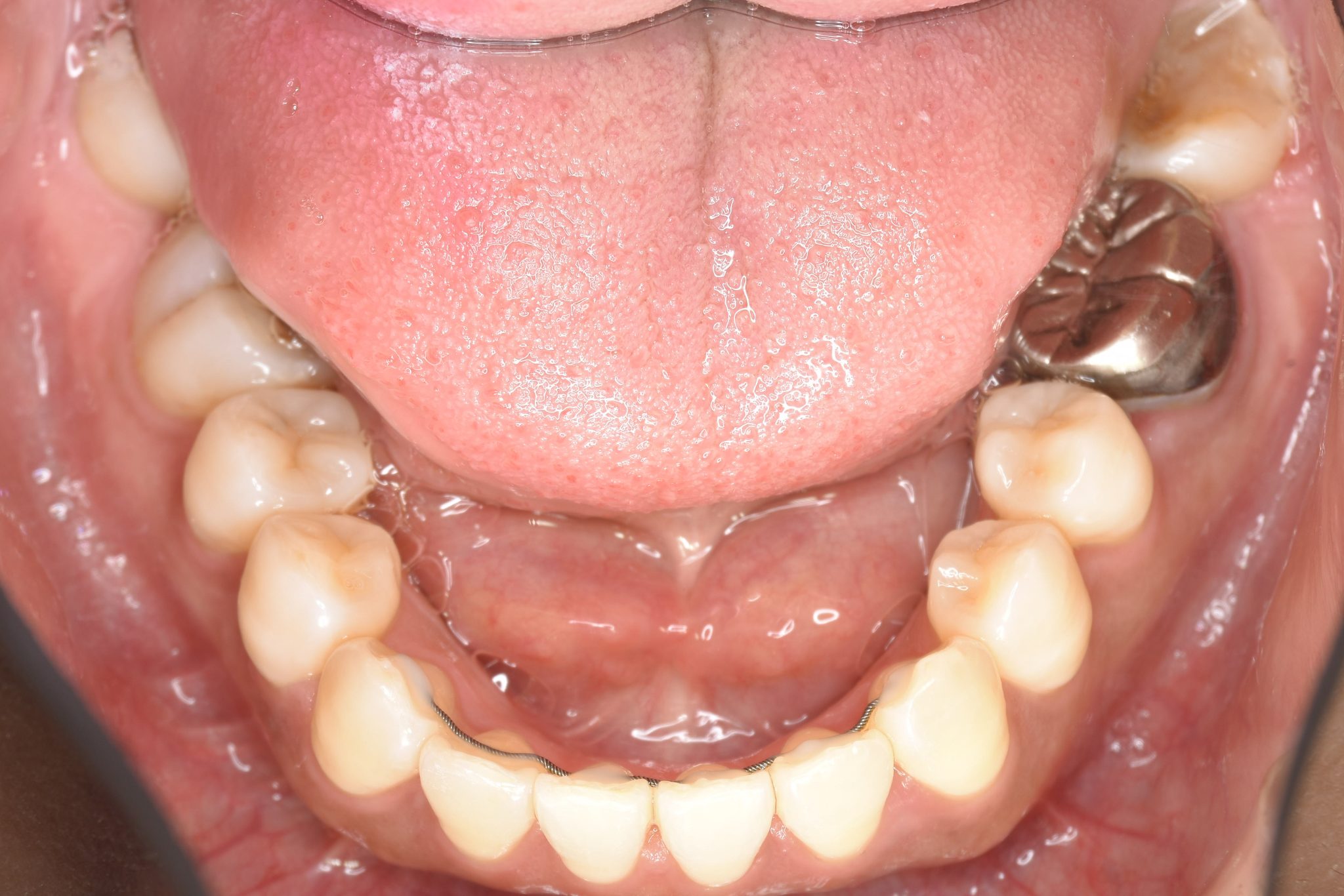 全顎ワイヤー矯正　症例_141