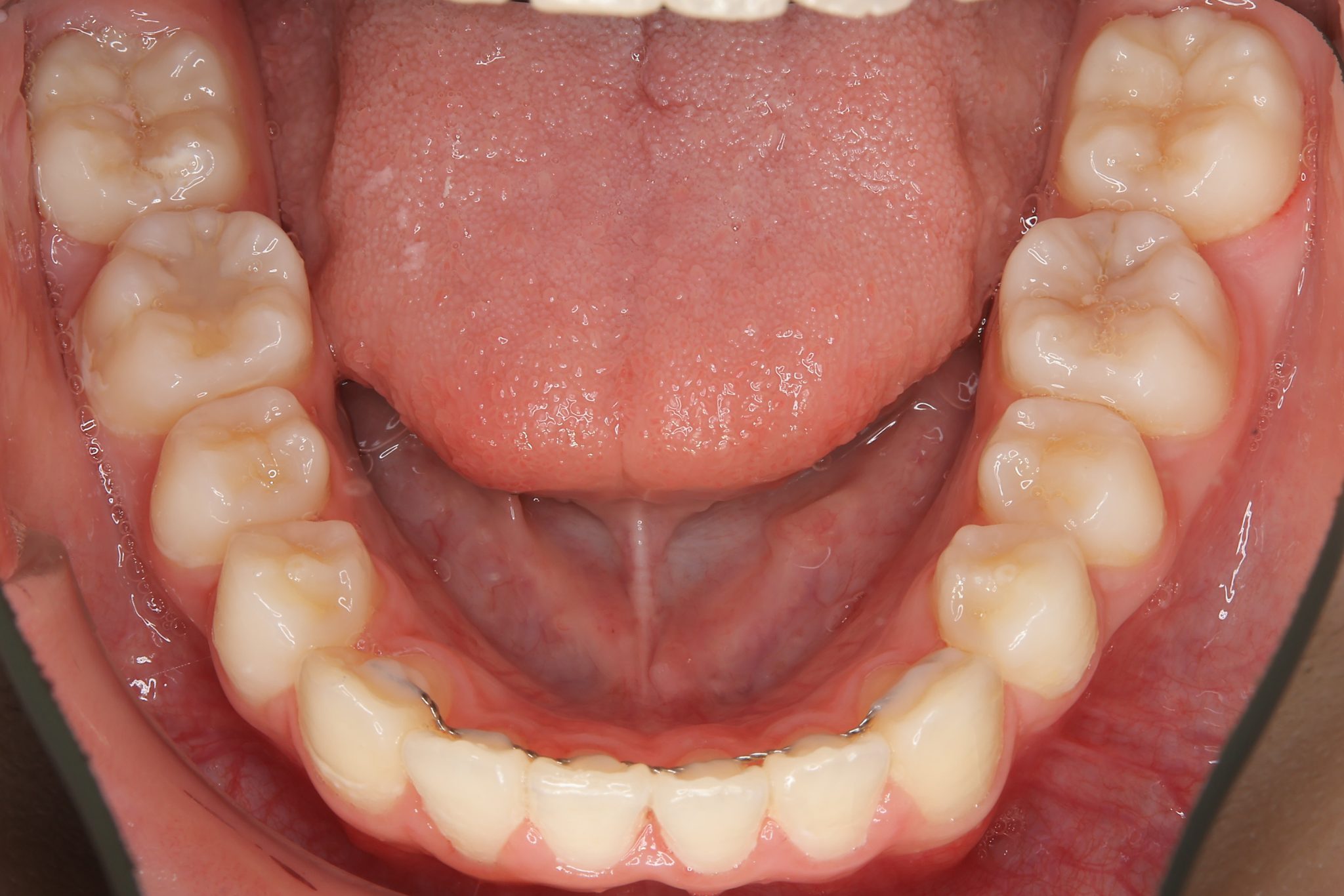 全顎ワイヤー矯正　症例_1324