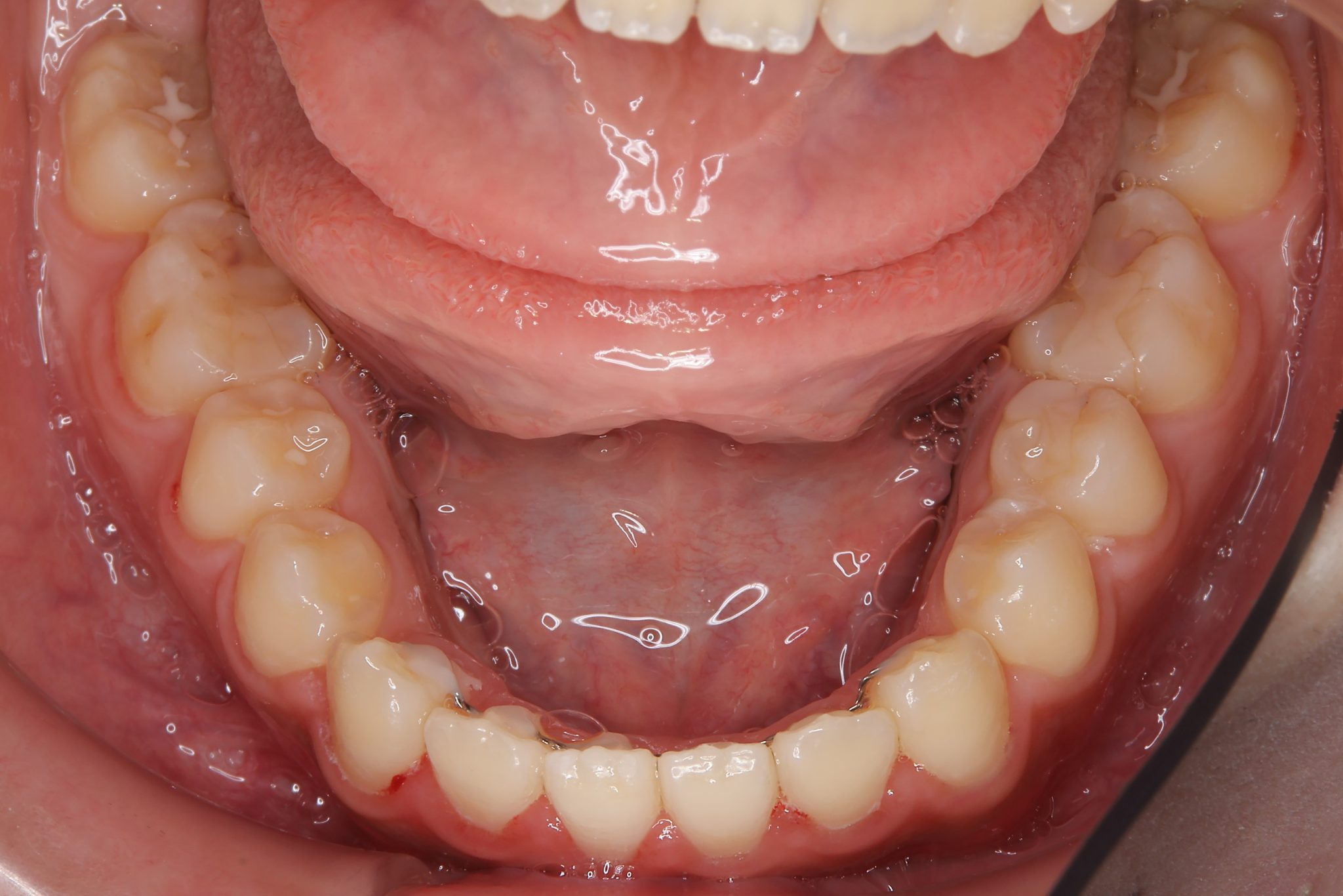 全顎ワイヤー矯正　症例_1409