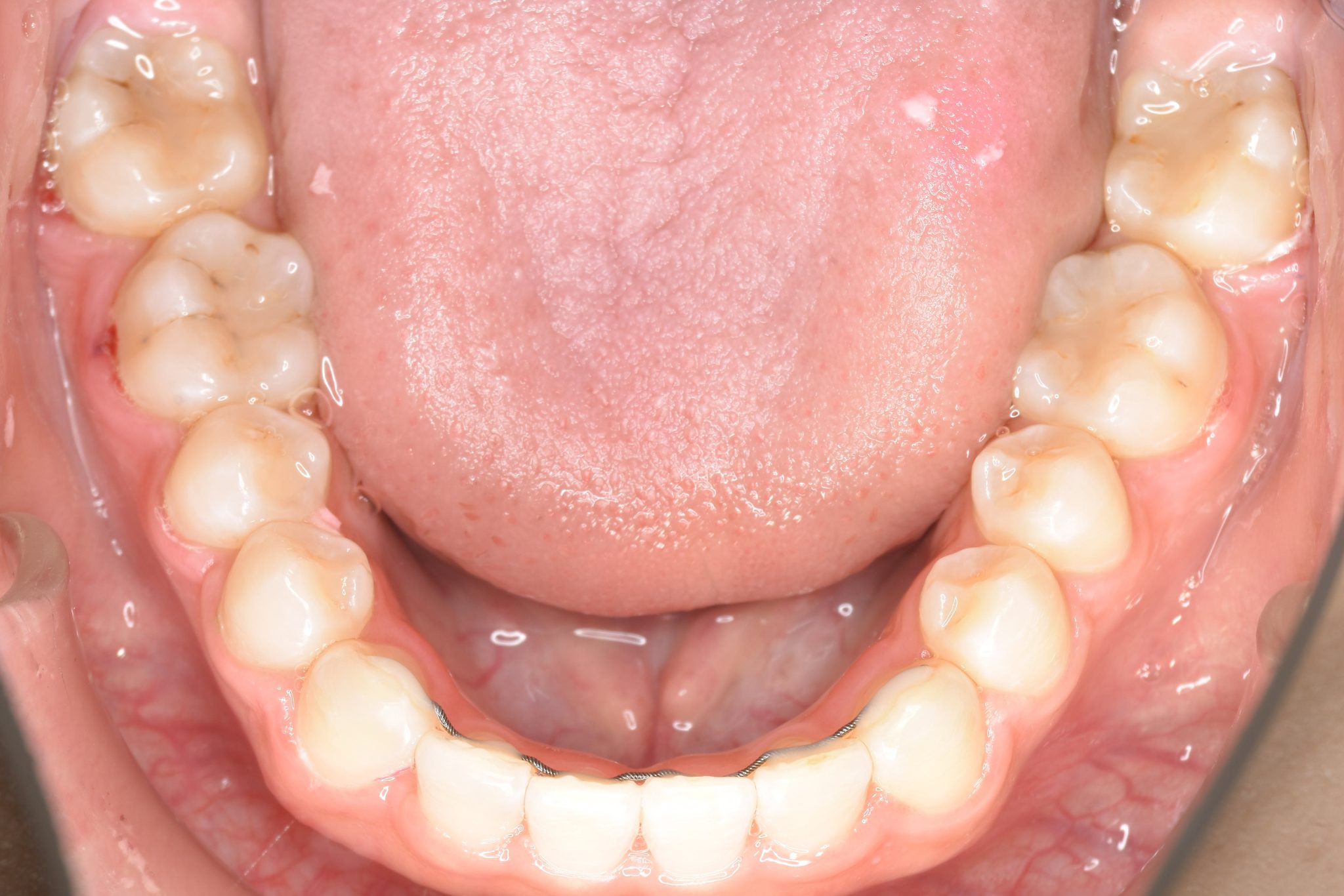 全顎ワイヤー矯正　症例_148