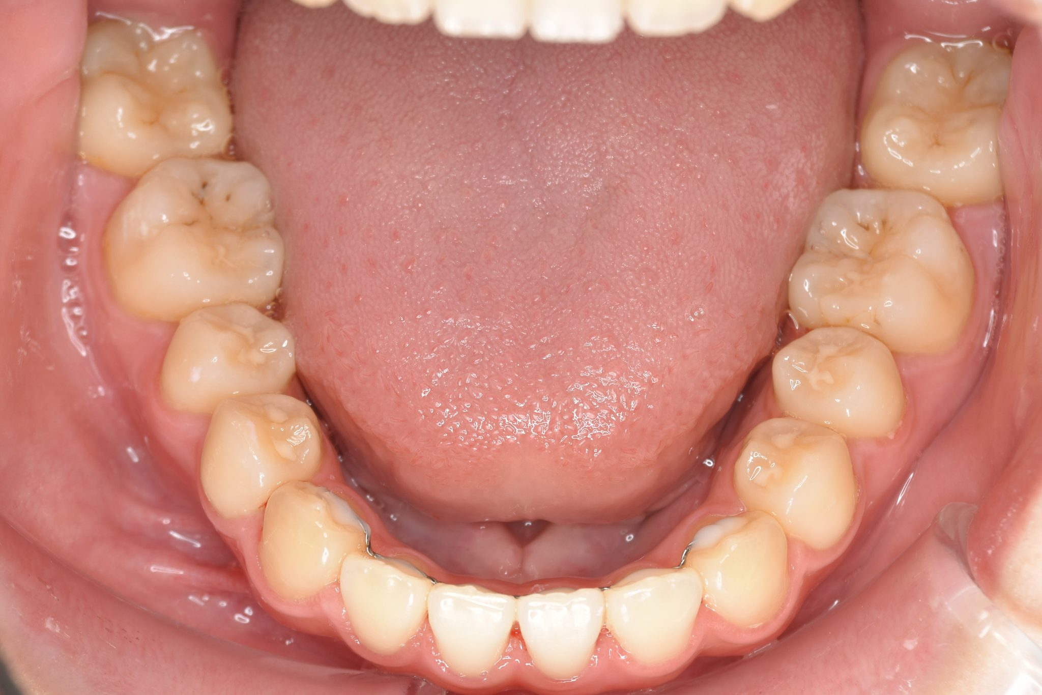 全顎ワイヤー矯正　症例_154