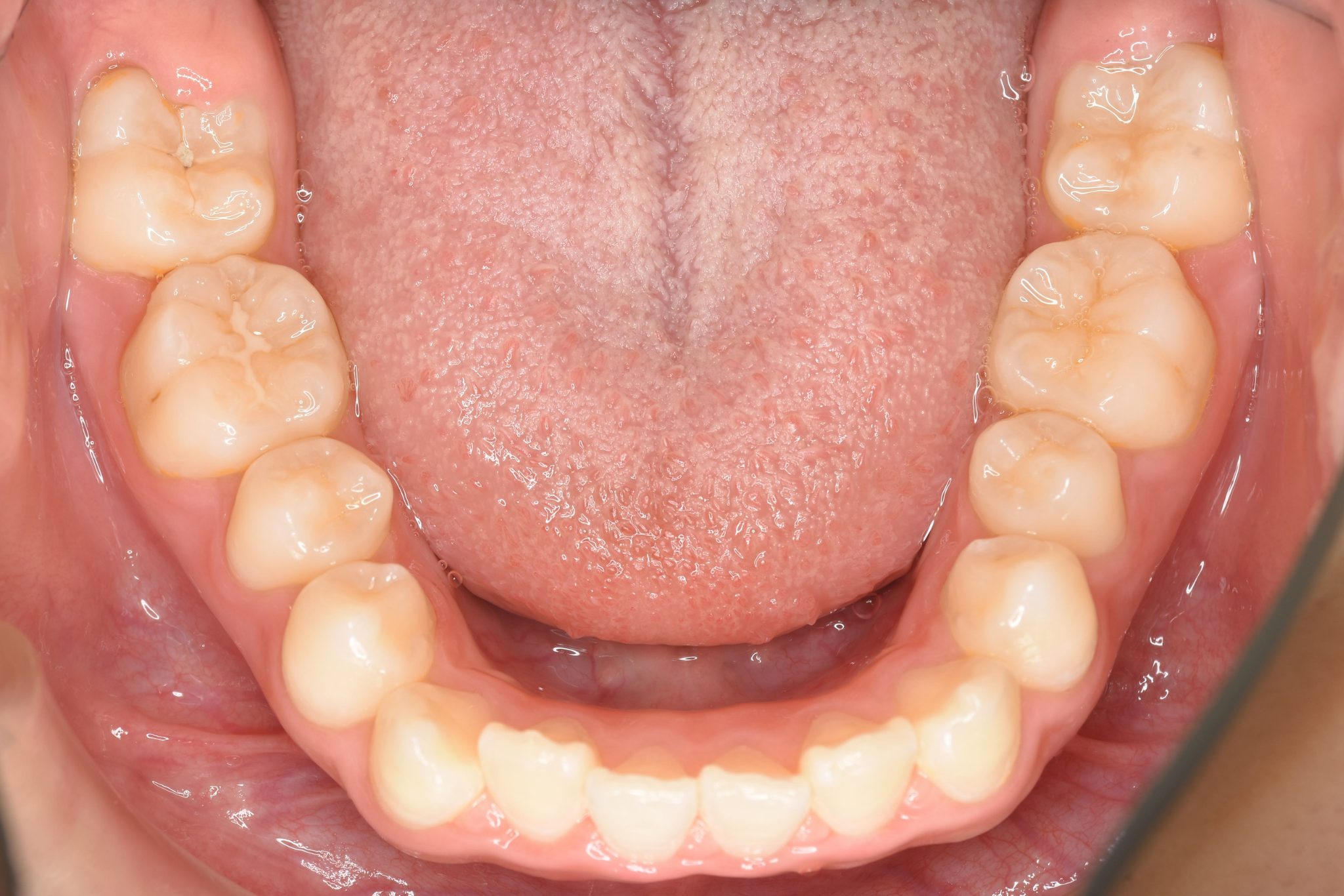 全顎ワイヤー矯正　症例_169