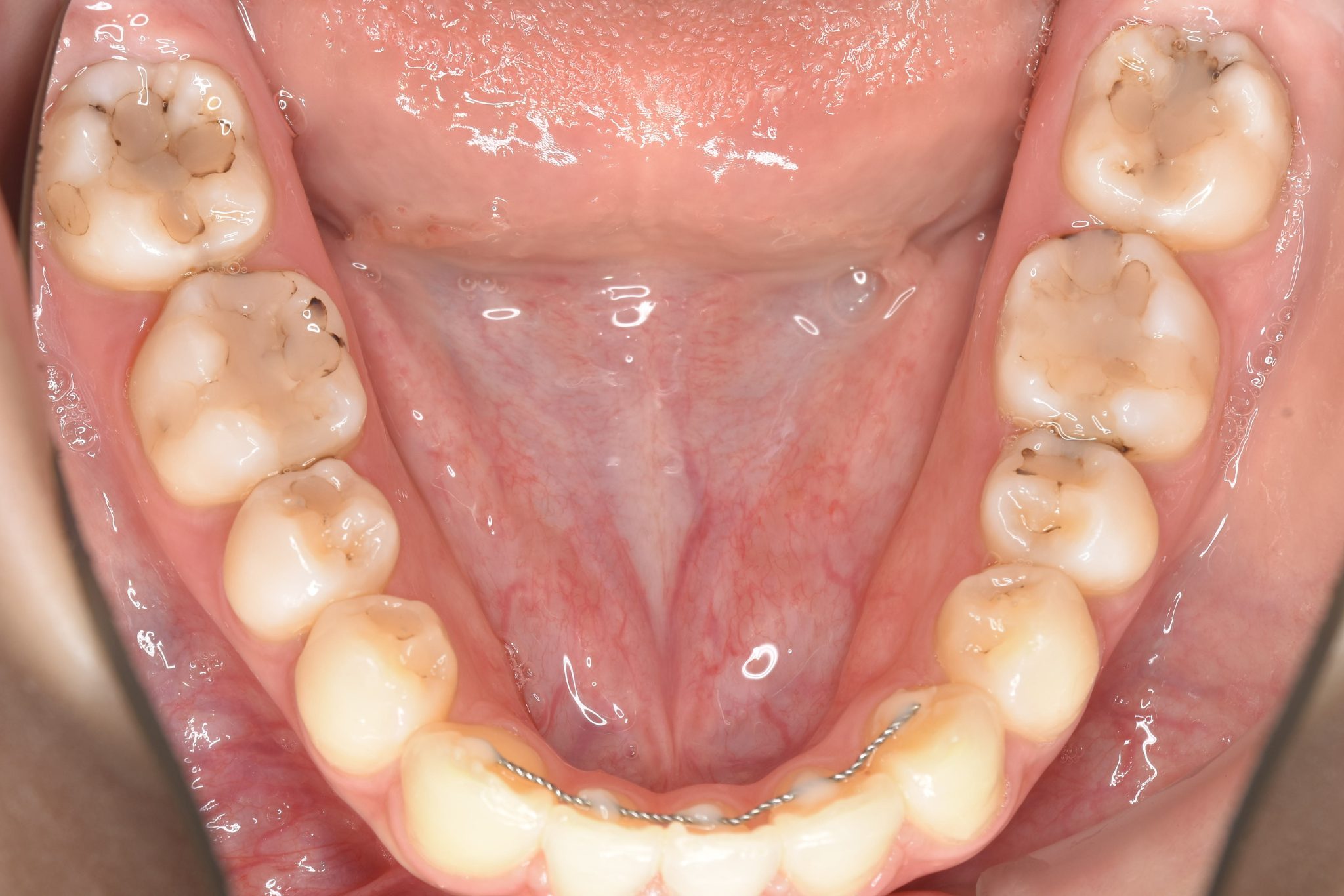 全顎ワイヤー矯正　症例_182