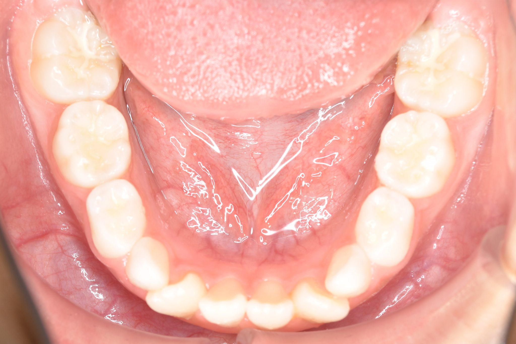 全顎ワイヤー矯正　症例_68