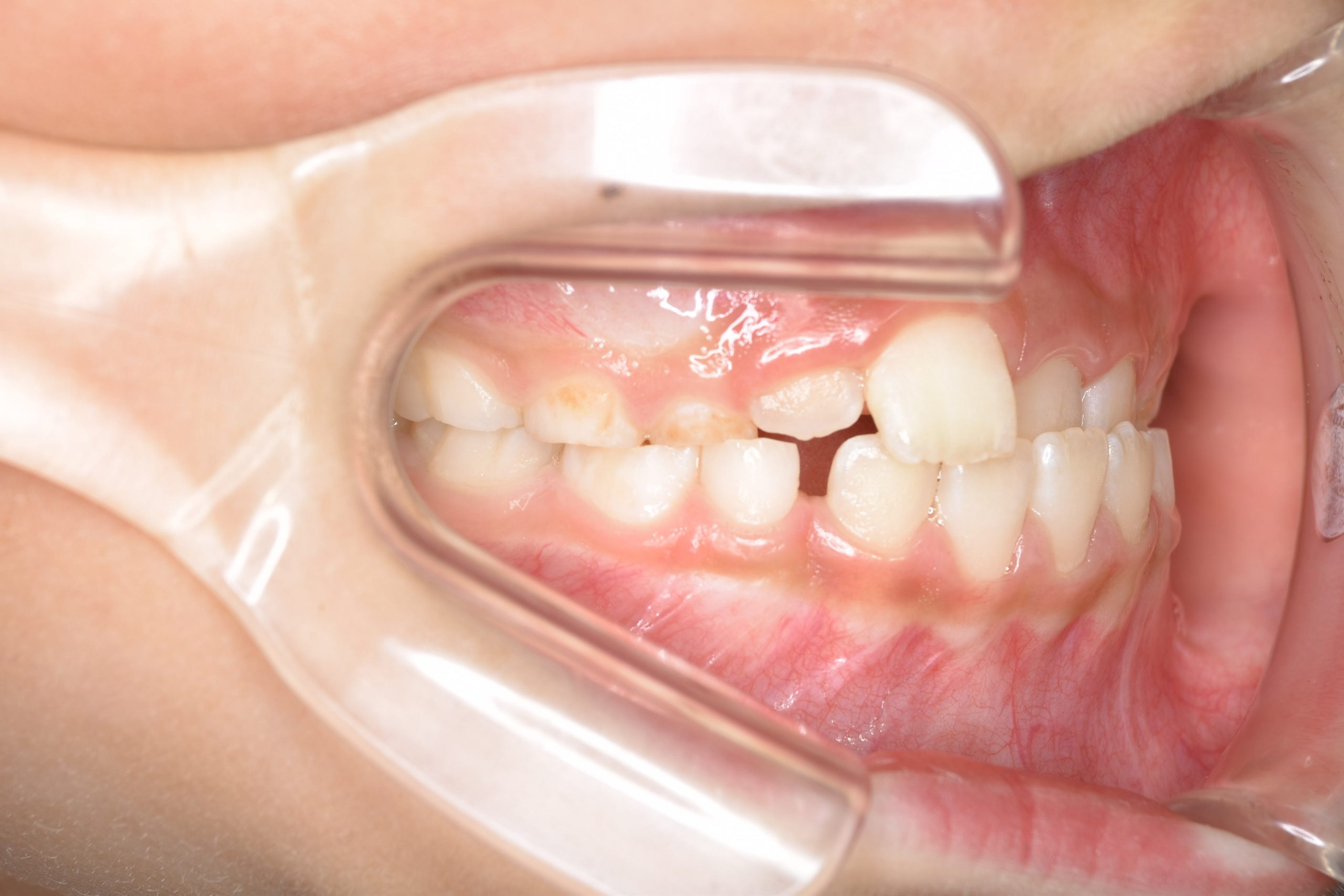 全顎ワイヤー矯正　症例_108