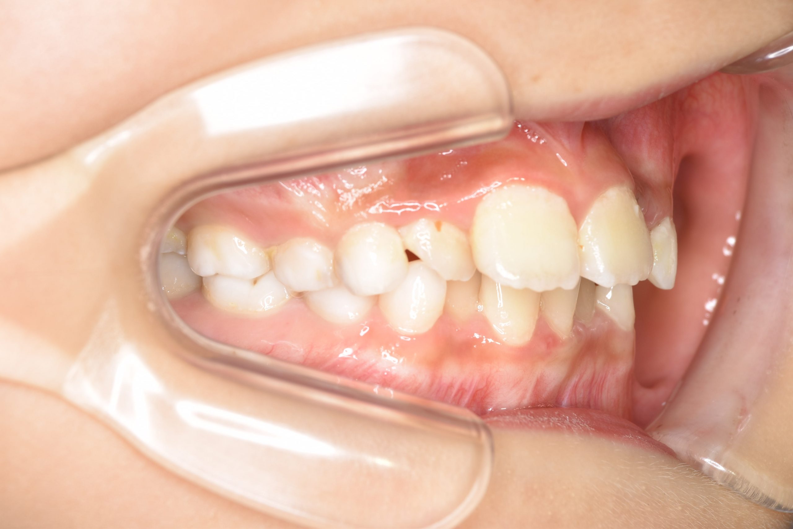 全顎ワイヤー矯正　症例_185