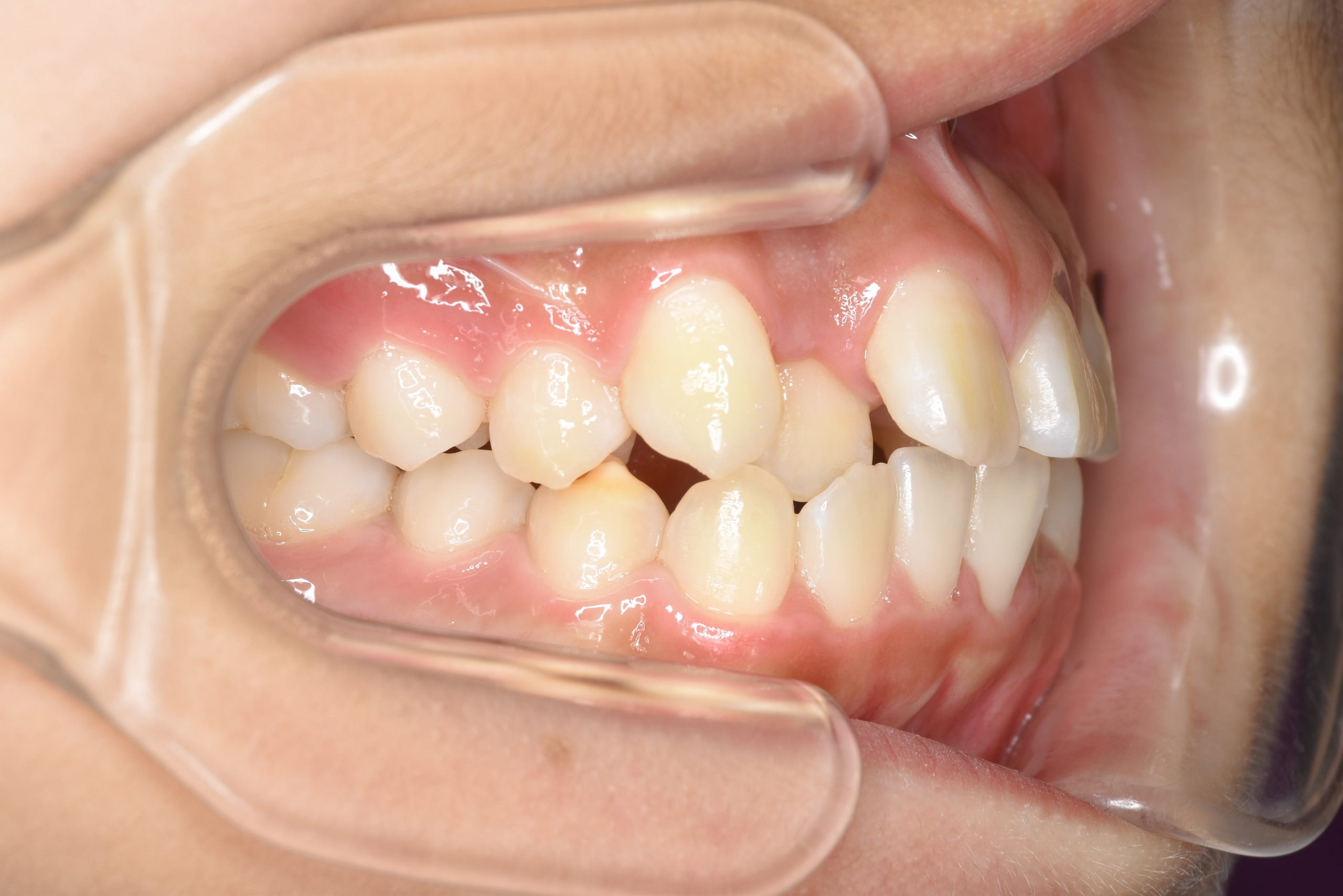 全顎ワイヤー矯正　症例_191