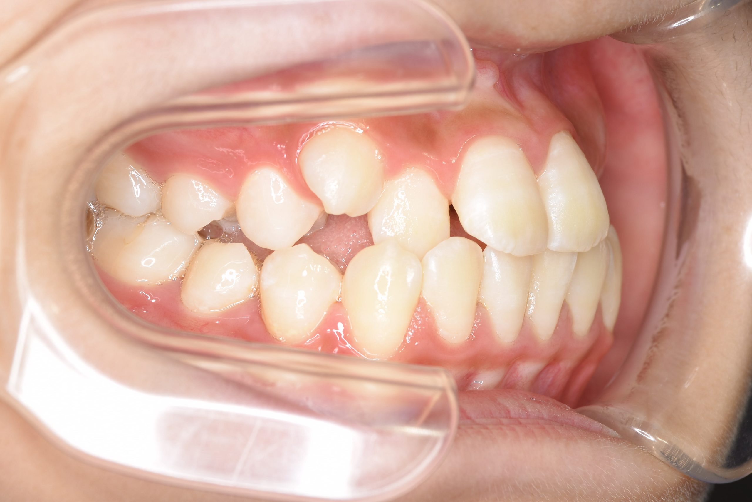 全顎ワイヤー矯正　症例_198