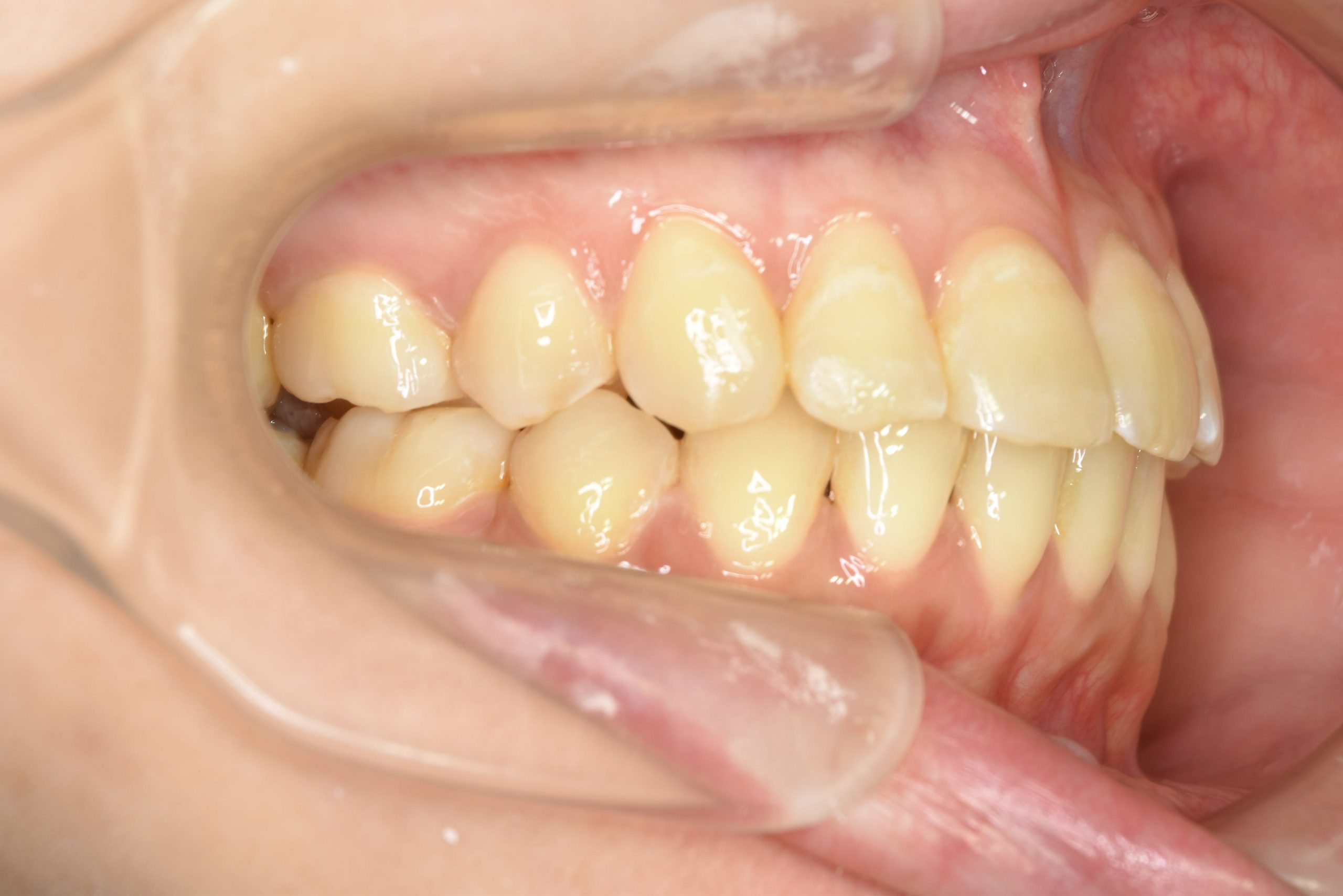 全顎ワイヤー矯正　症例_200