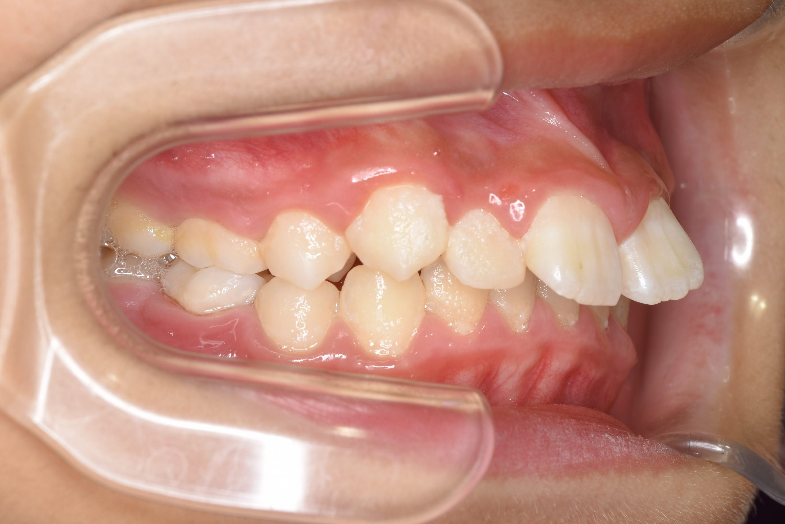 全顎ワイヤー矯正　症例_218