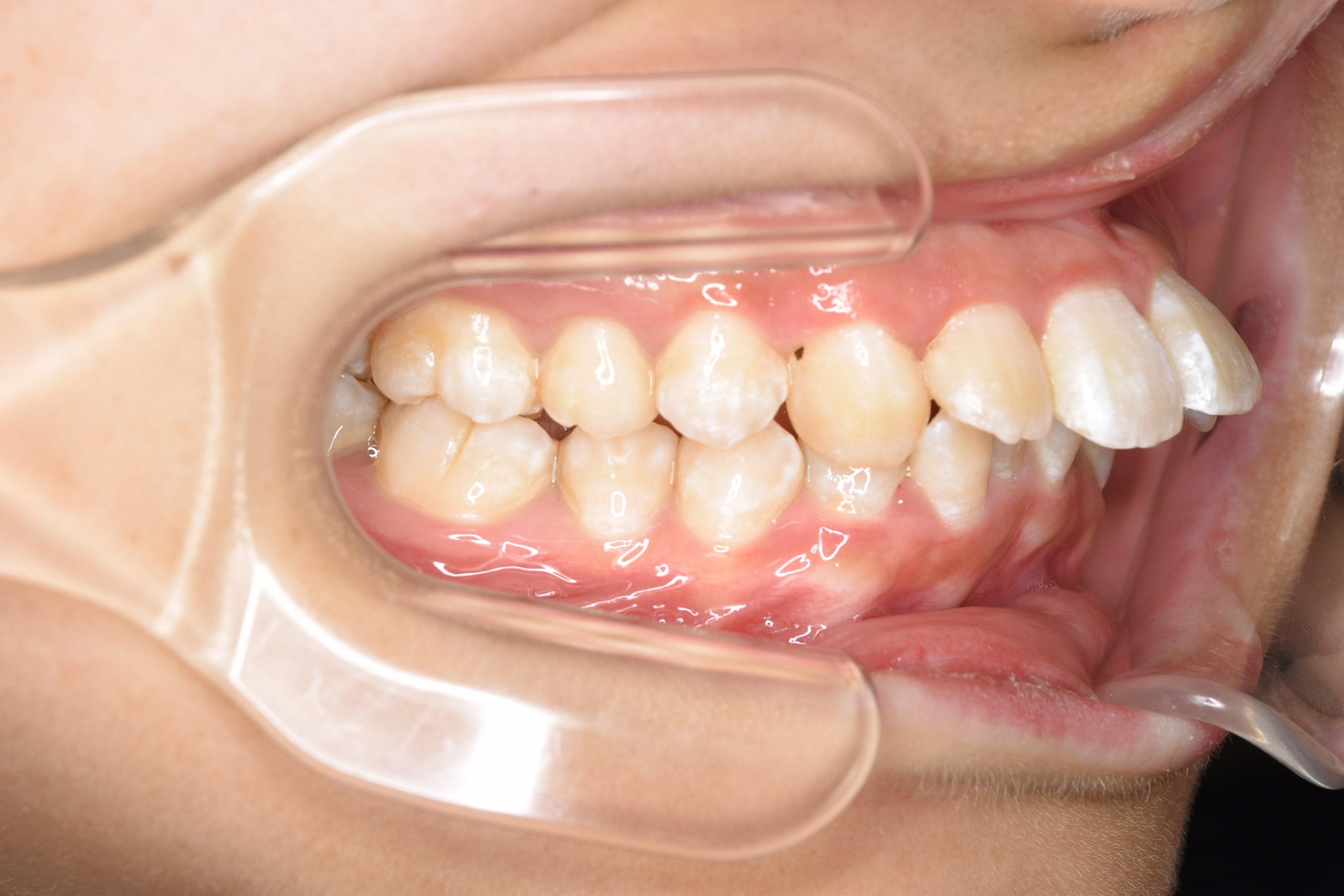 全顎ワイヤー矯正　症例_252