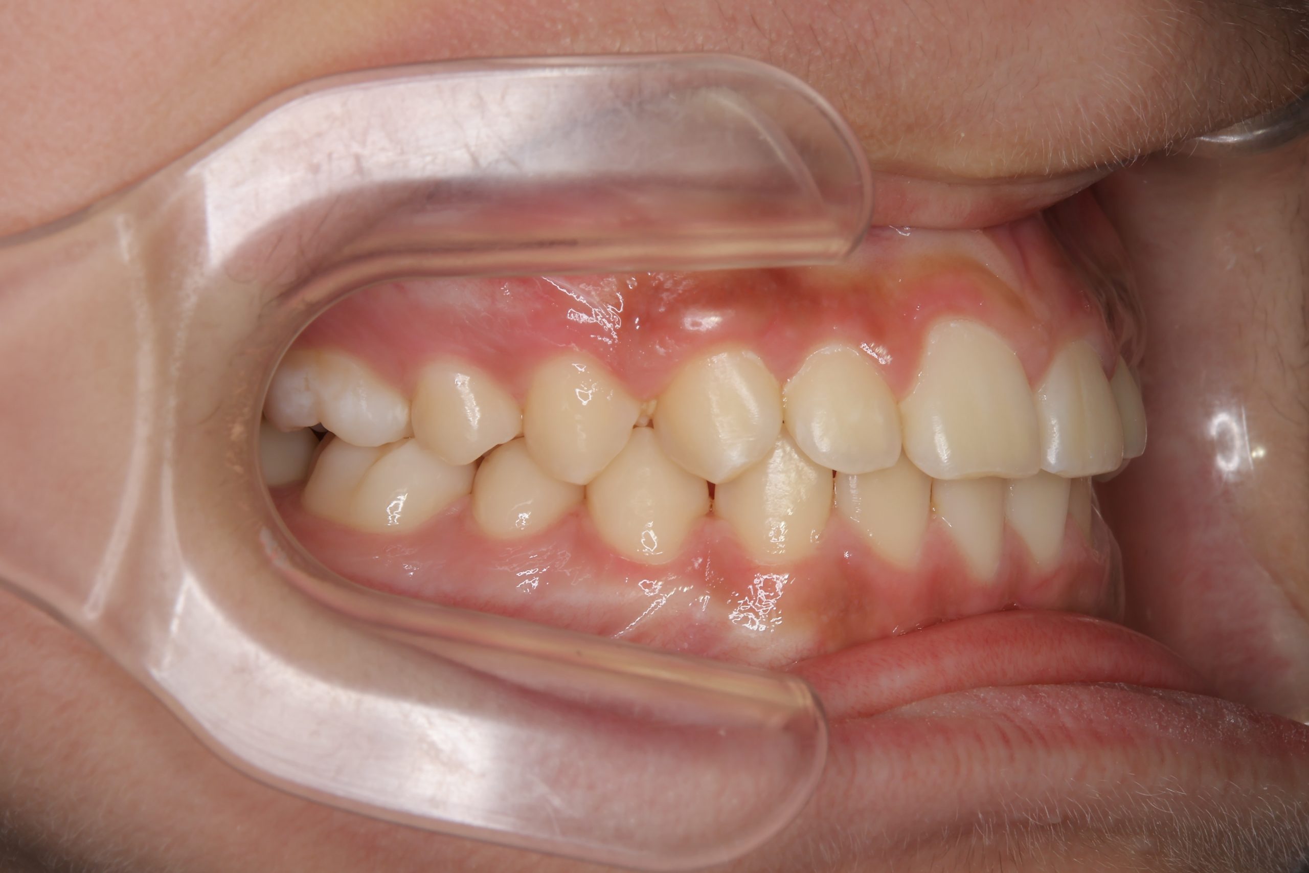 全顎ワイヤー矯正　症例_261