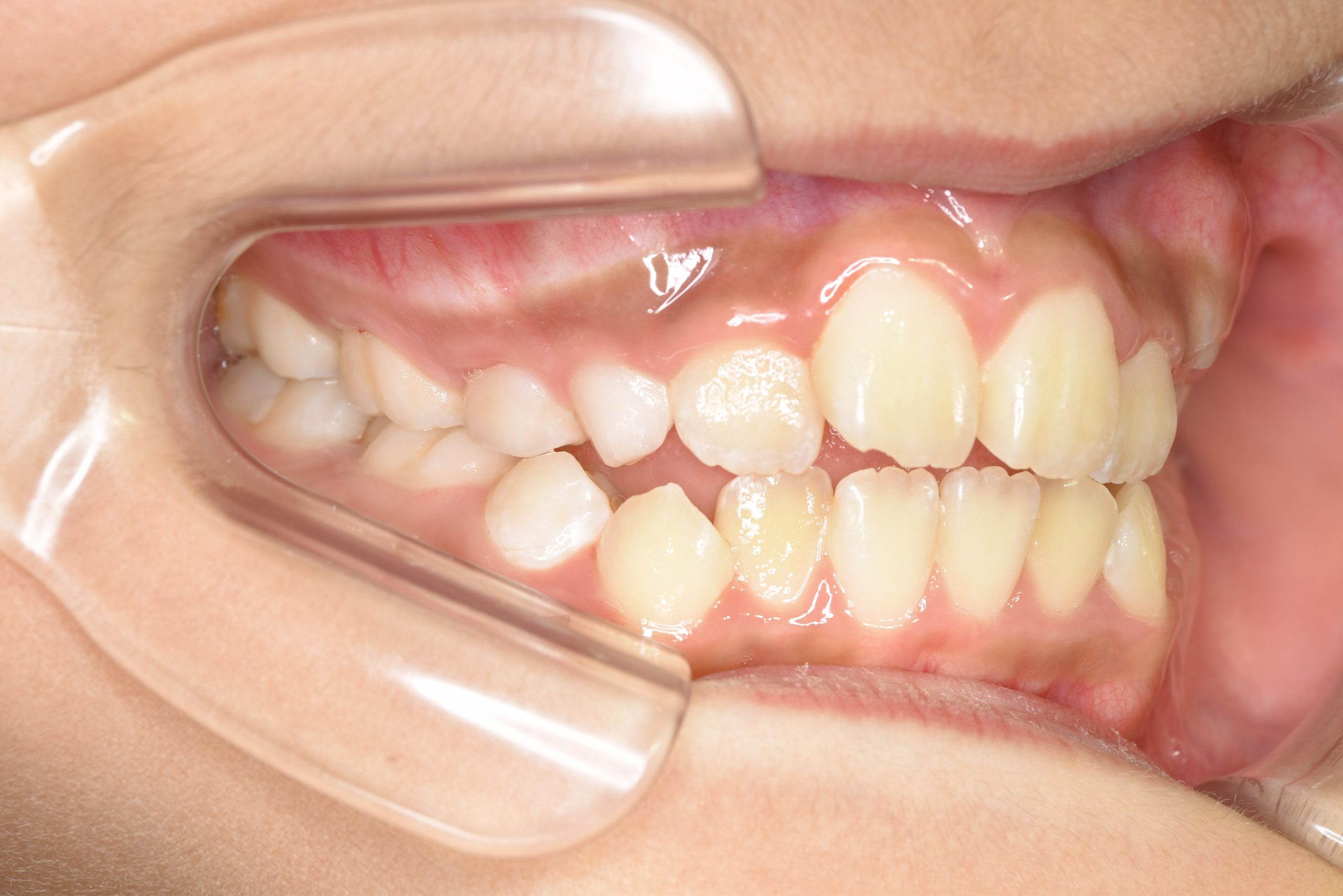 全顎ワイヤー矯正　症例_267