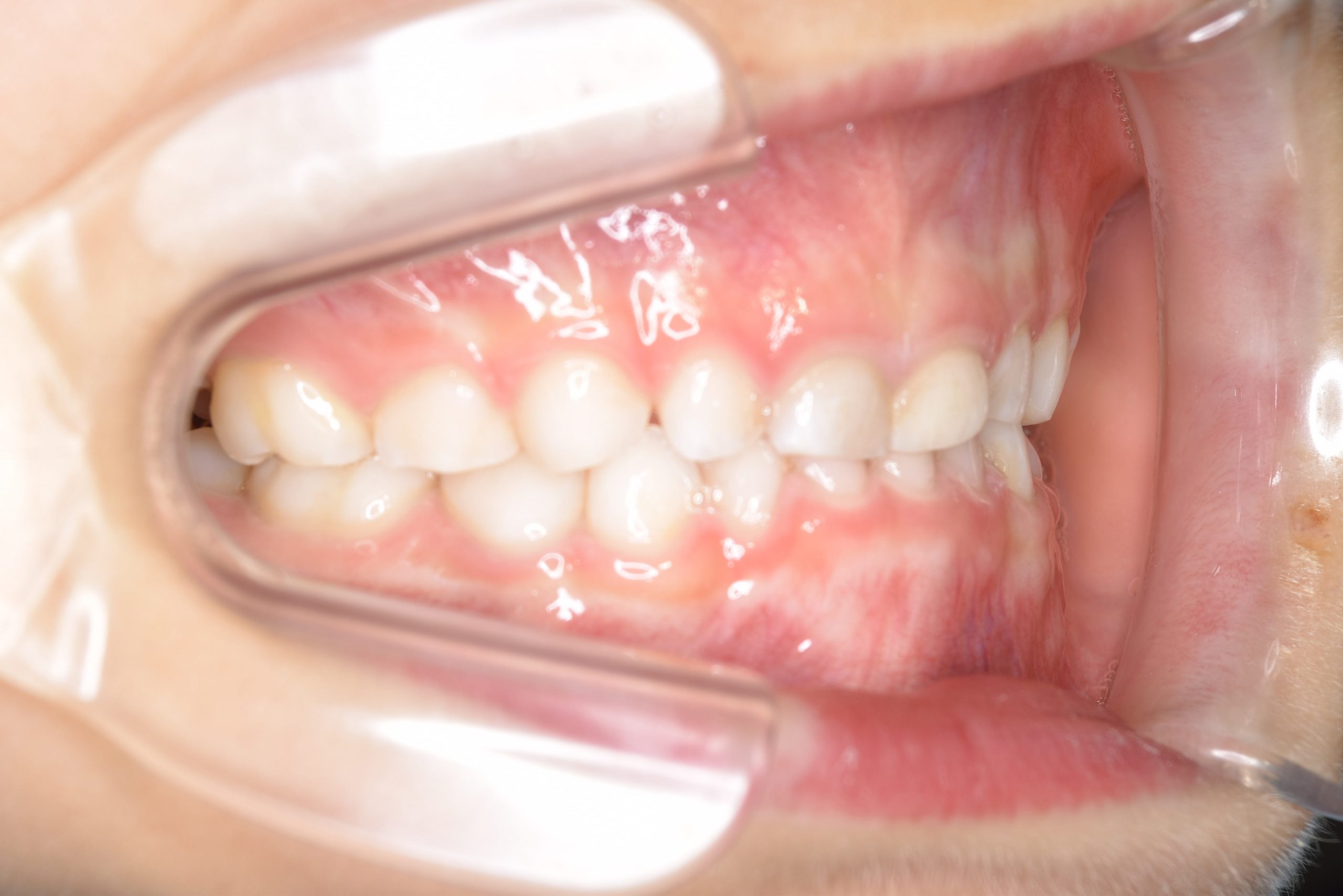 全顎ワイヤー矯正　症例_121