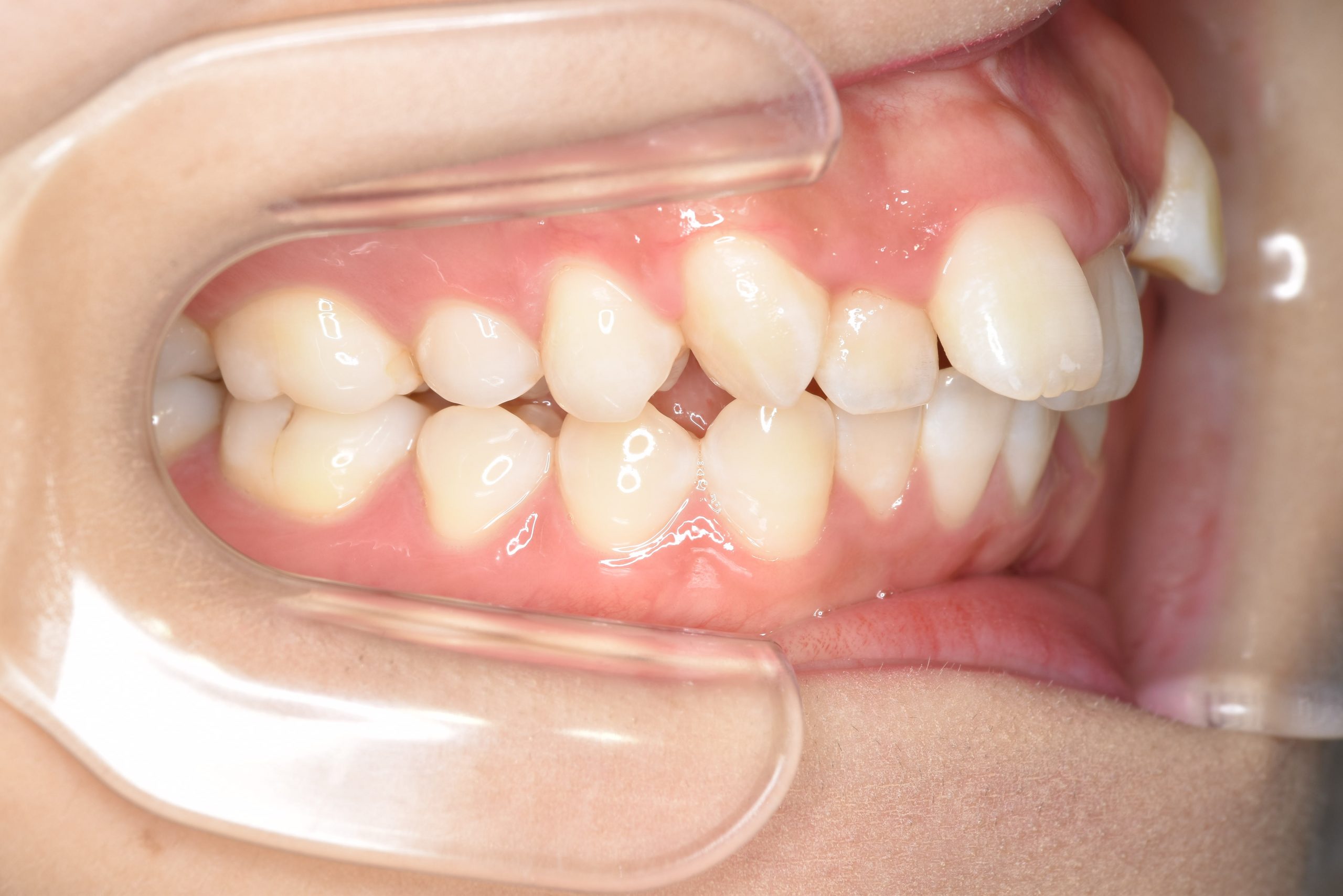 全顎ワイヤー矯正　症例_306