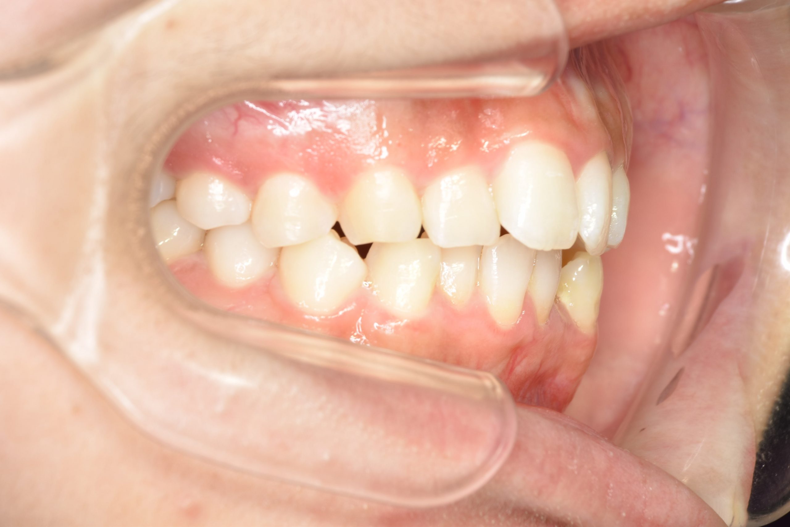 全顎ワイヤー矯正　症例_315