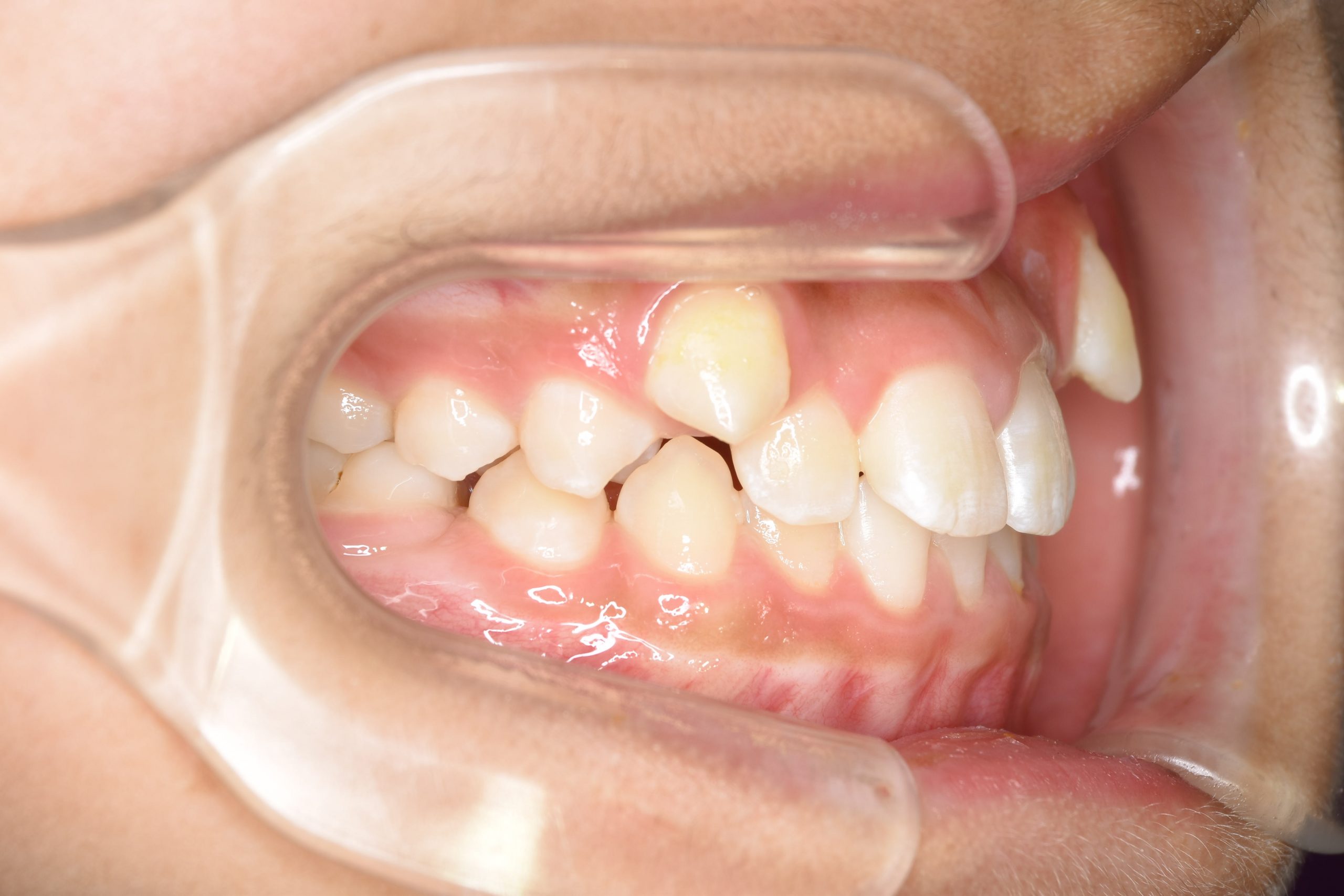 全顎ワイヤー矯正　症例_320