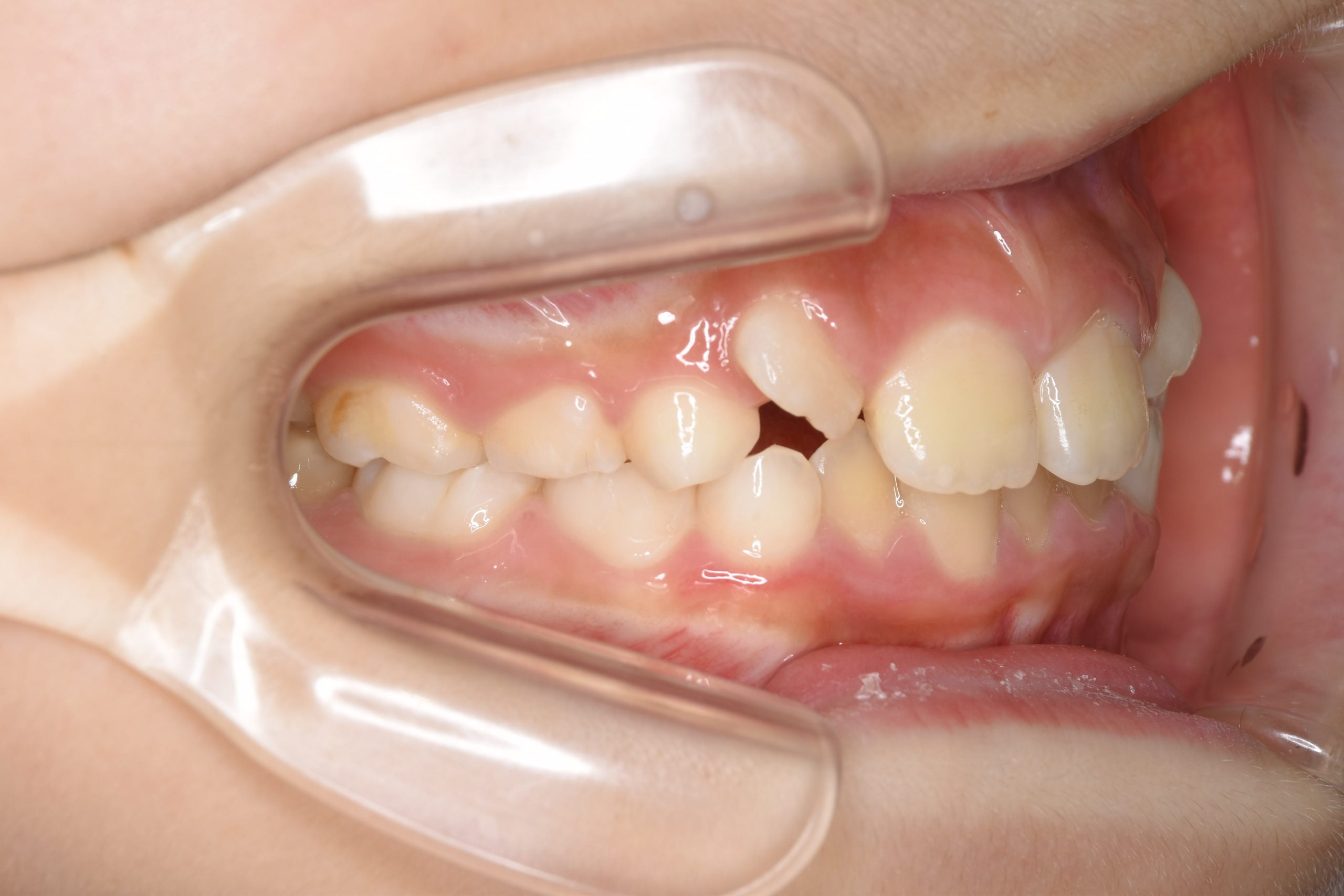 全顎ワイヤー矯正　症例_347