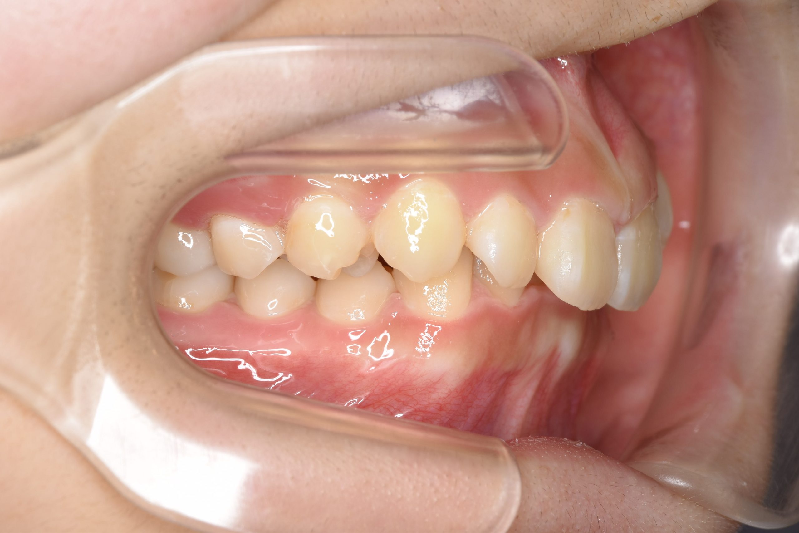 全顎ワイヤー矯正　症例_349