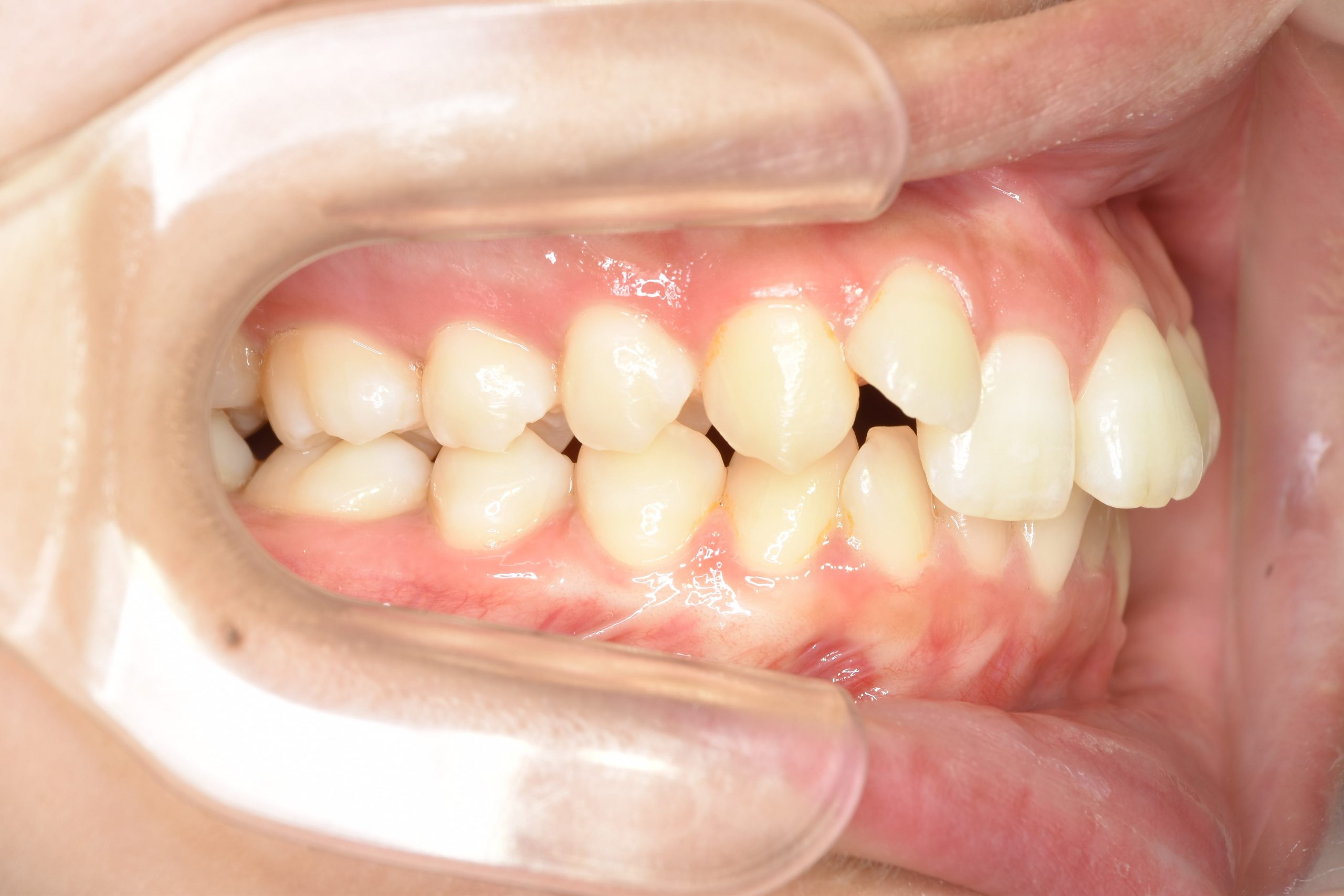 全顎ワイヤー矯正　症例_418