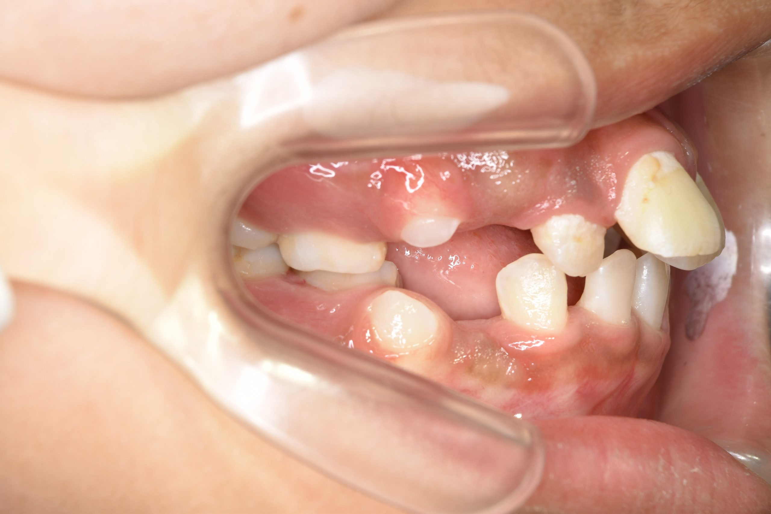 全顎ワイヤー矯正　症例_474