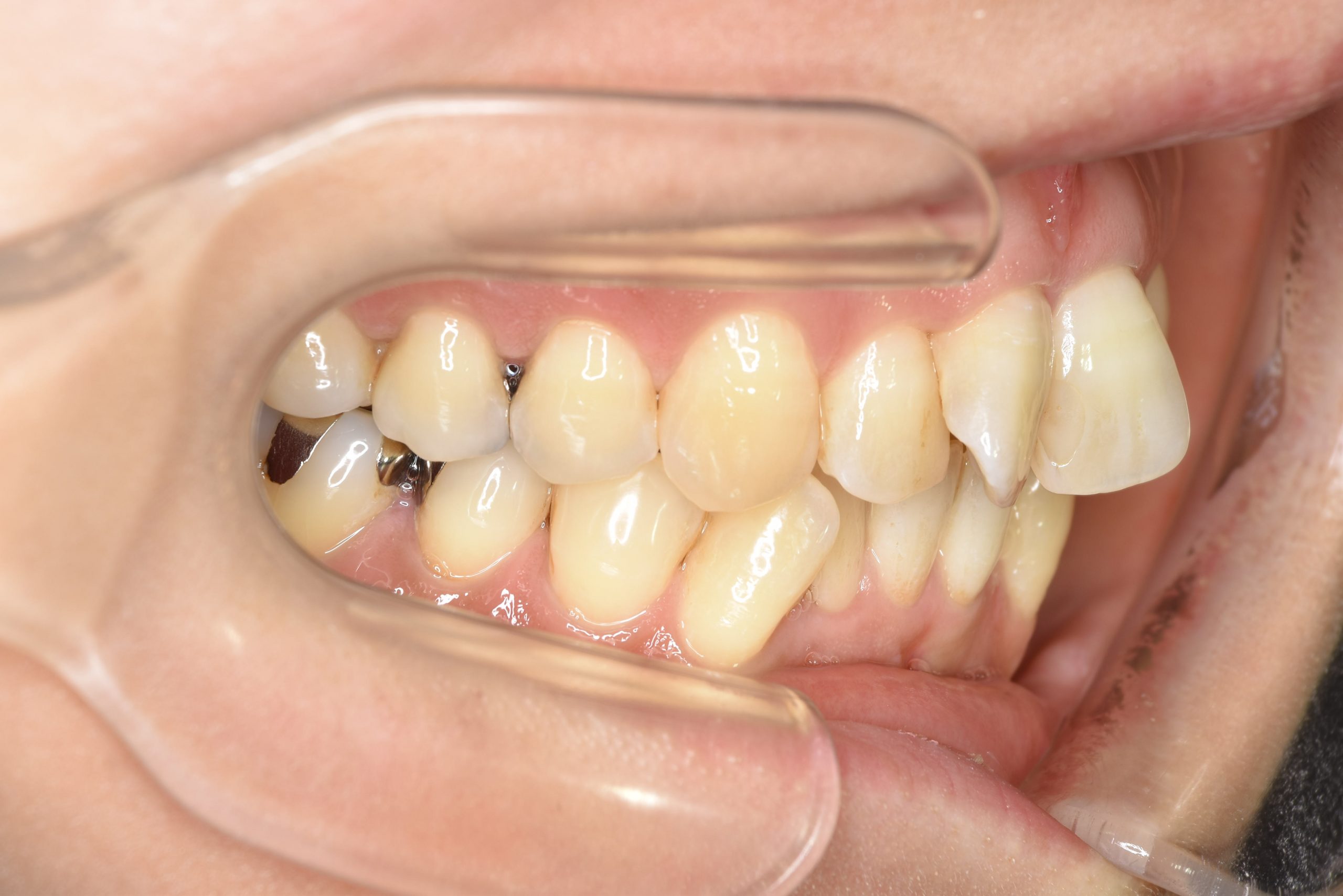 全顎ワイヤー矯正　症例_479