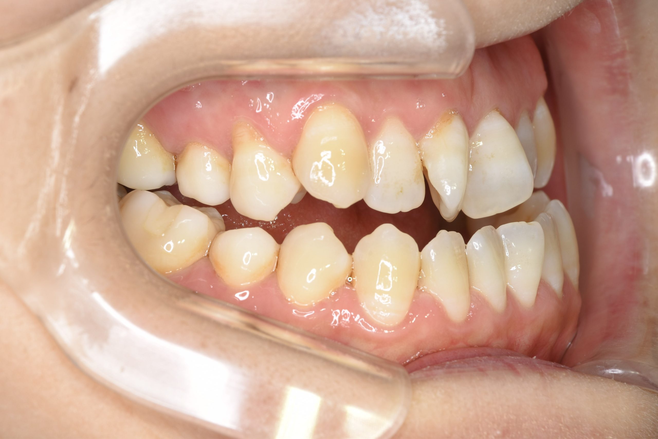 全顎ワイヤー矯正　症例_138